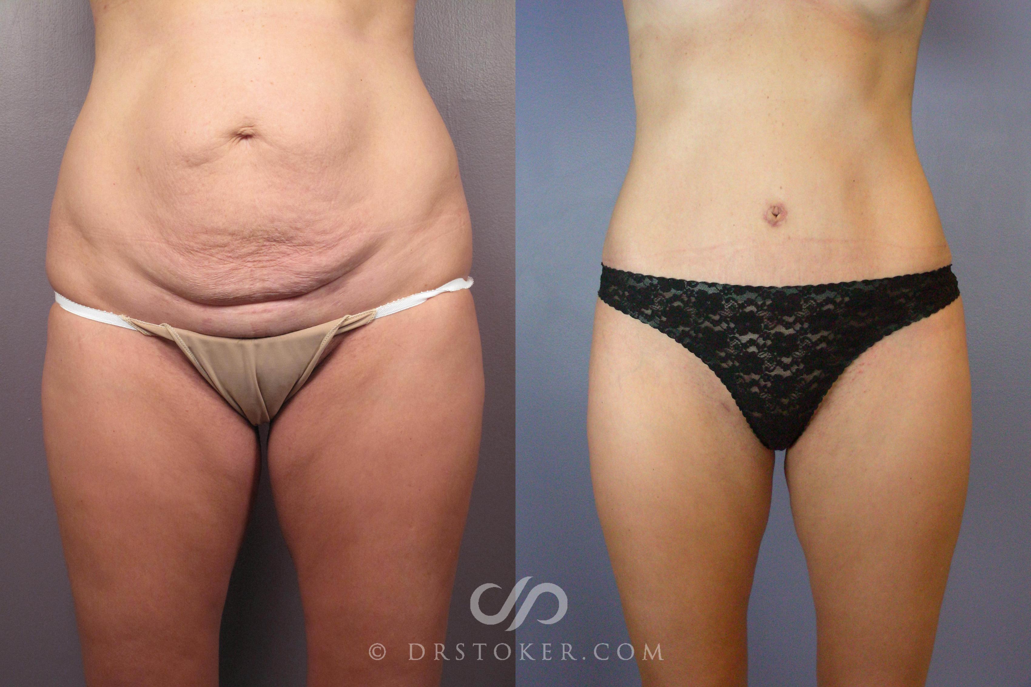 Before & After Tummy Tuck Case 441 View #1 View in Los Angeles, CA