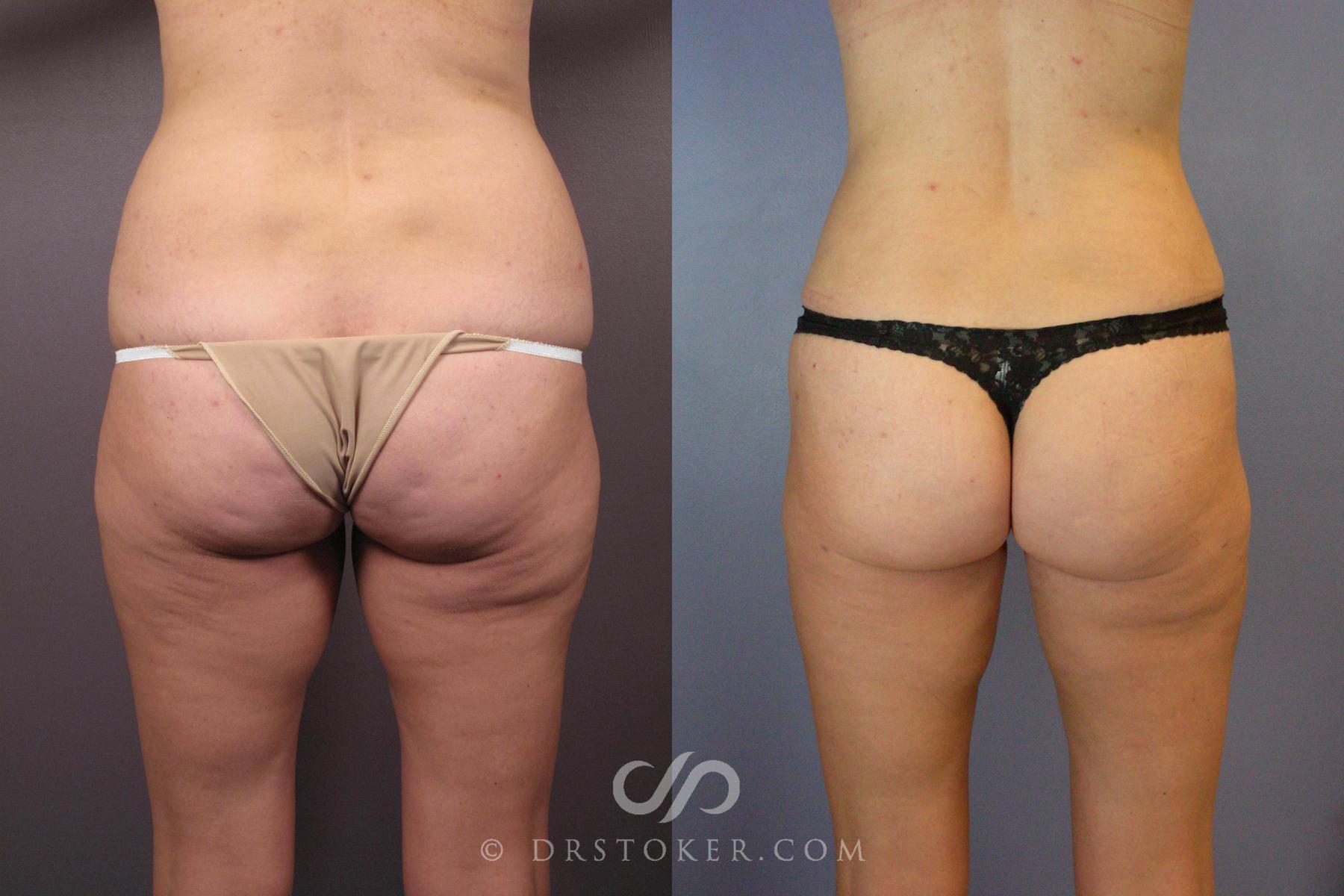 Before & After Tummy Tuck Case 441 View #2 View in Los Angeles, CA