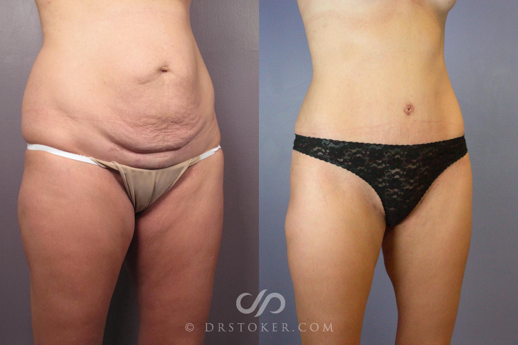 Before & After Tummy Tuck Case 441 View #3 View in Los Angeles, CA