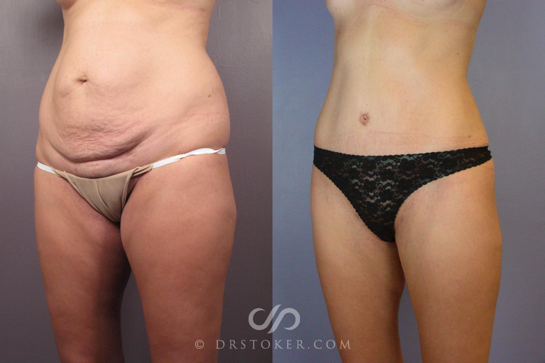 Before & After Tummy Tuck Case 441 View #4 View in Los Angeles, CA