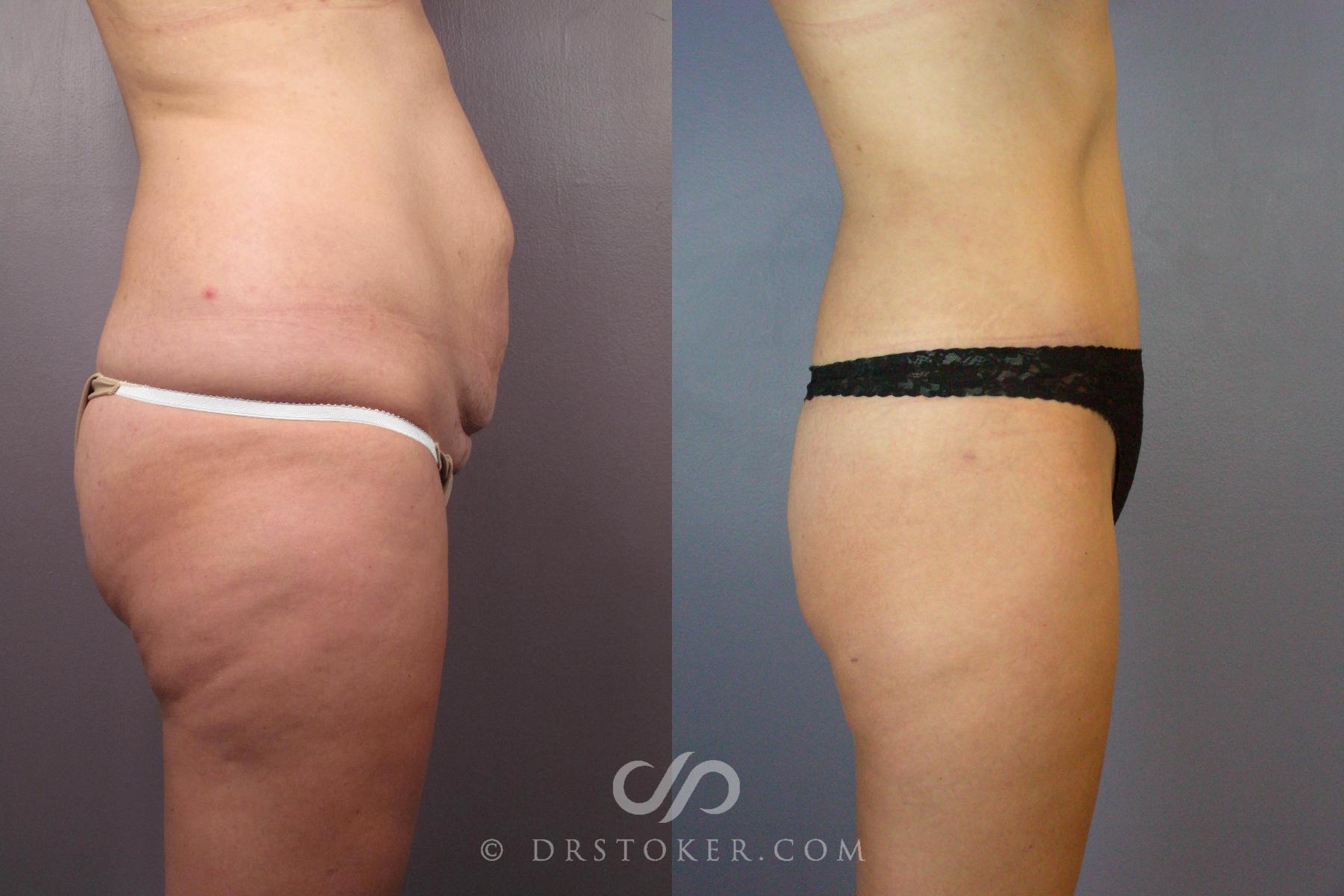 Before & After Tummy Tuck Case 441 View #5 View in Los Angeles, CA