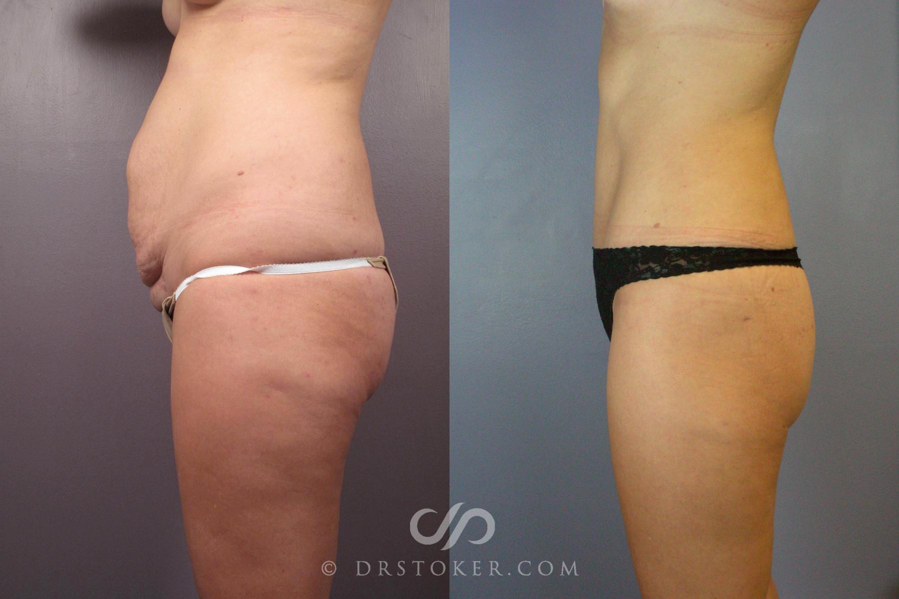 Before & After Tummy Tuck Case 441 View #6 View in Los Angeles, CA