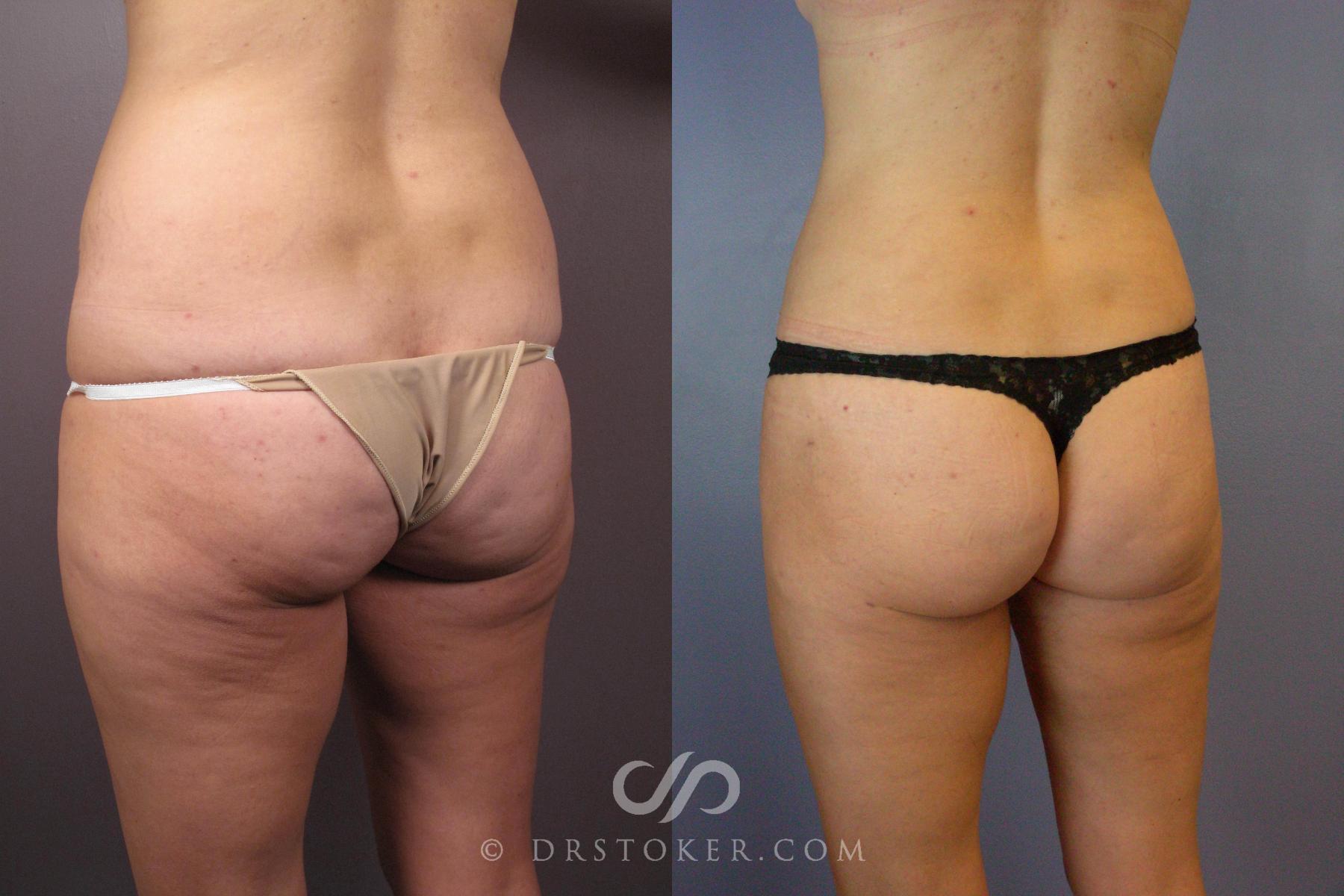 Before & After Tummy Tuck Case 441 View #7 View in Los Angeles, CA