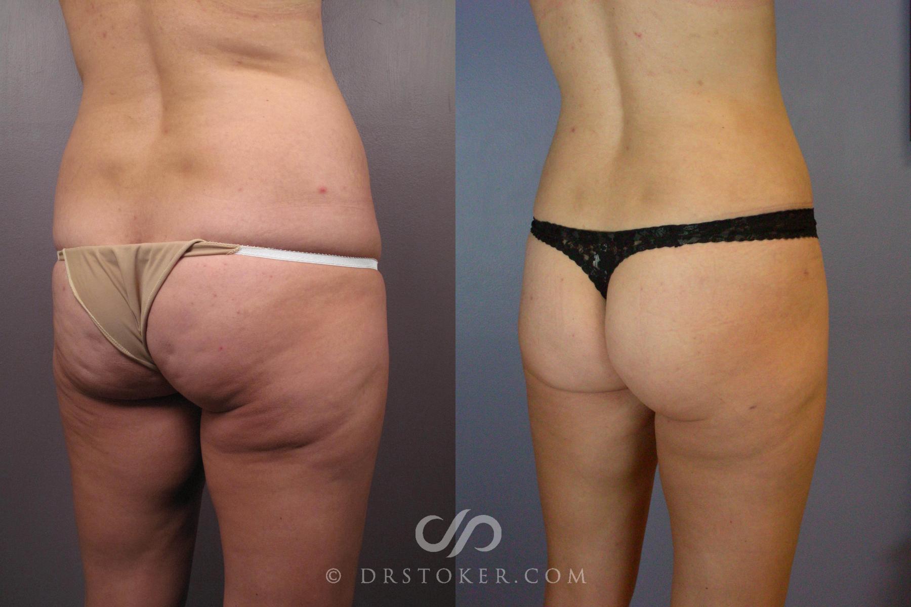 Before & After Tummy Tuck Case 441 View #8 View in Los Angeles, CA