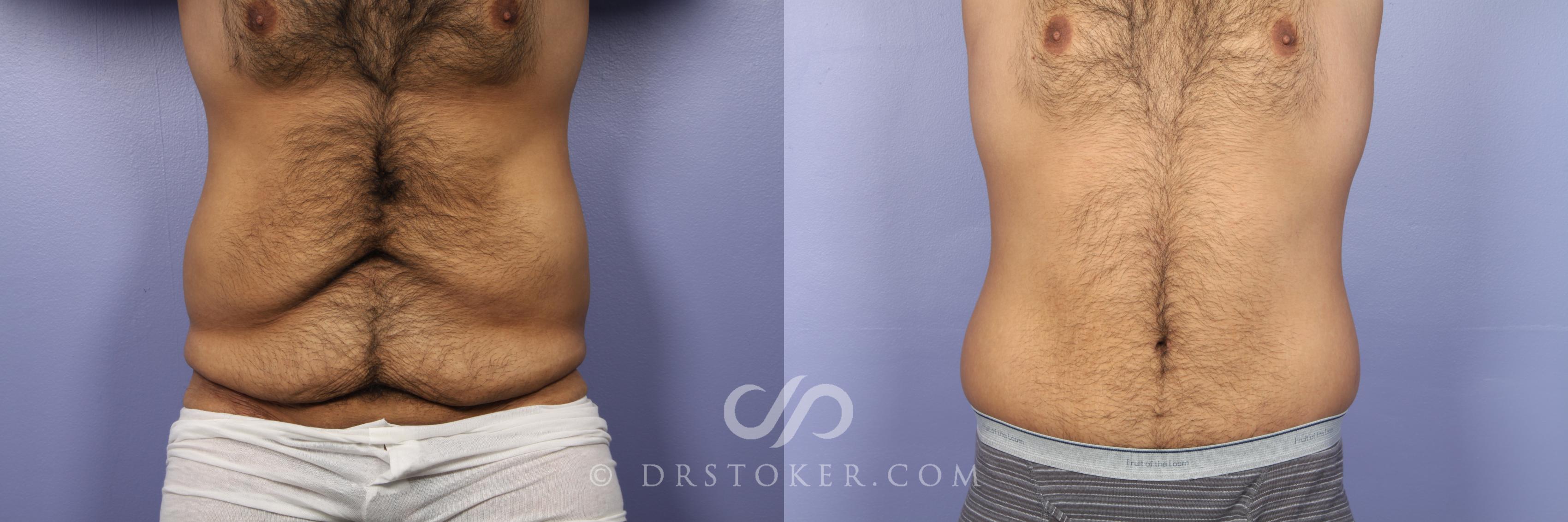 Before & After Tummy Tuck for Men Case 442 View #1 View in Marina del Rey, CA