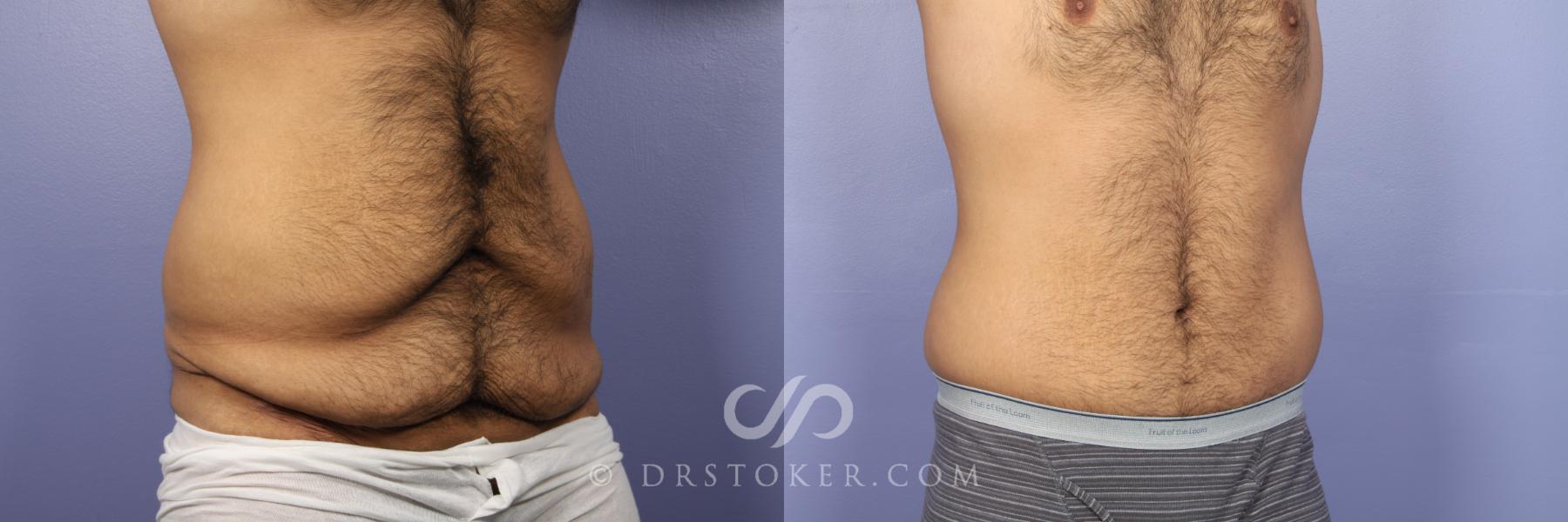 Before & After Tummy Tuck for Men Case 442 View #2 View in Los Angeles, CA