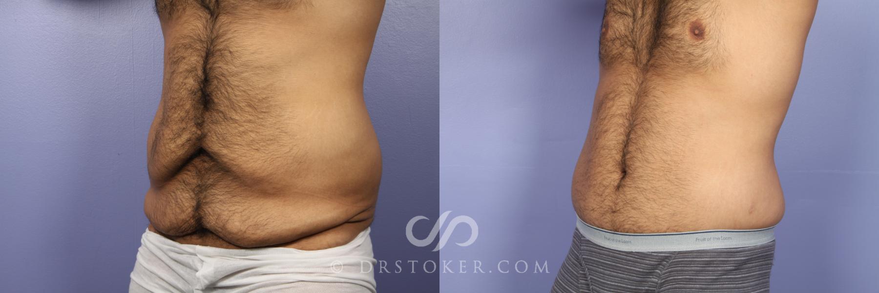 Before & After Tummy Tuck for Men Case 442 View #3 View in Los Angeles, CA