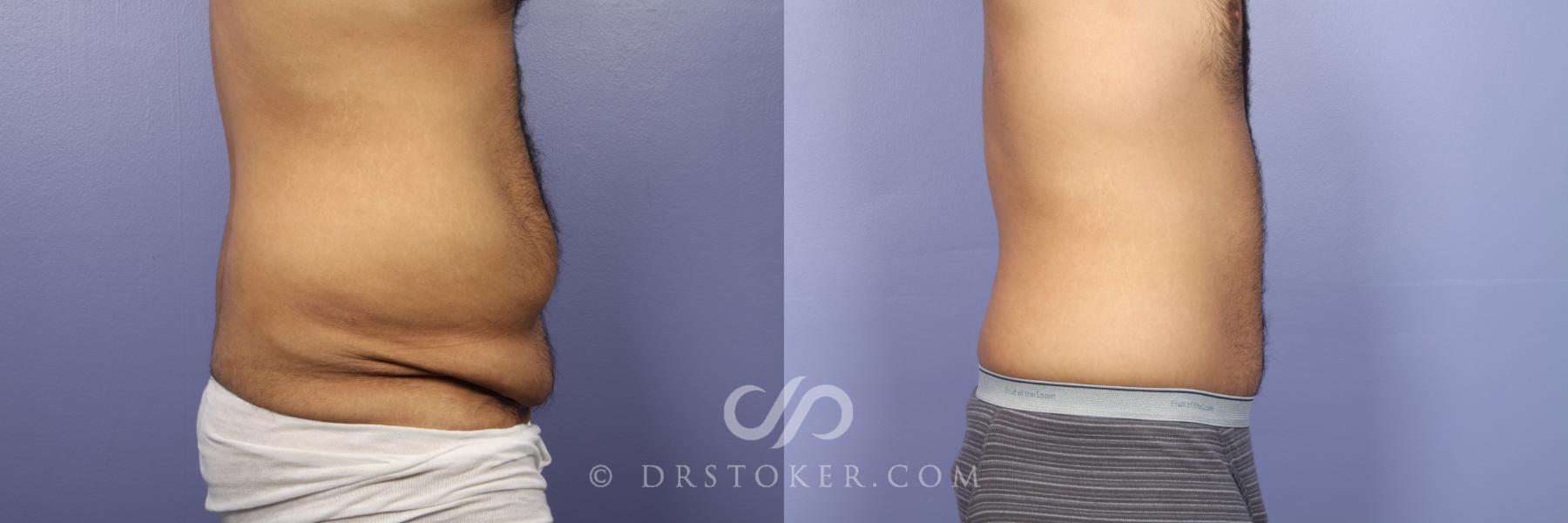 Before & After Tummy Tuck Case 442 View #4 View in Los Angeles, CA