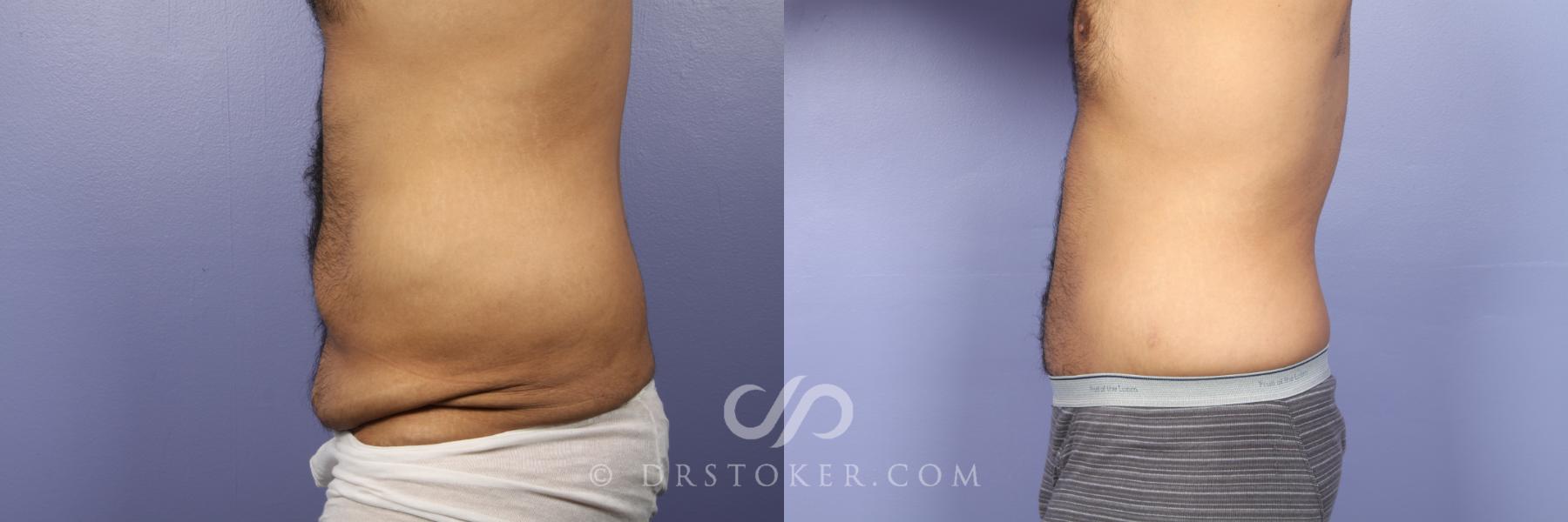Before & After Tummy Tuck for Men Case 442 View #5 View in Los Angeles, CA