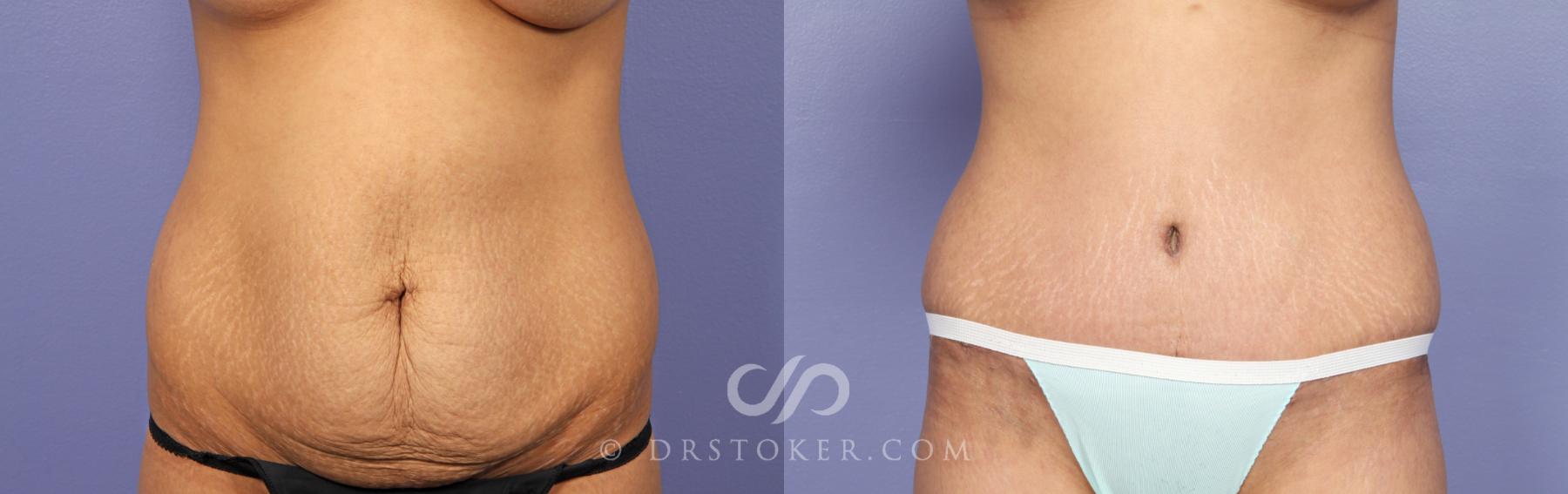 Before & After Tummy Tuck Case 469 View #1 View in Los Angeles, CA