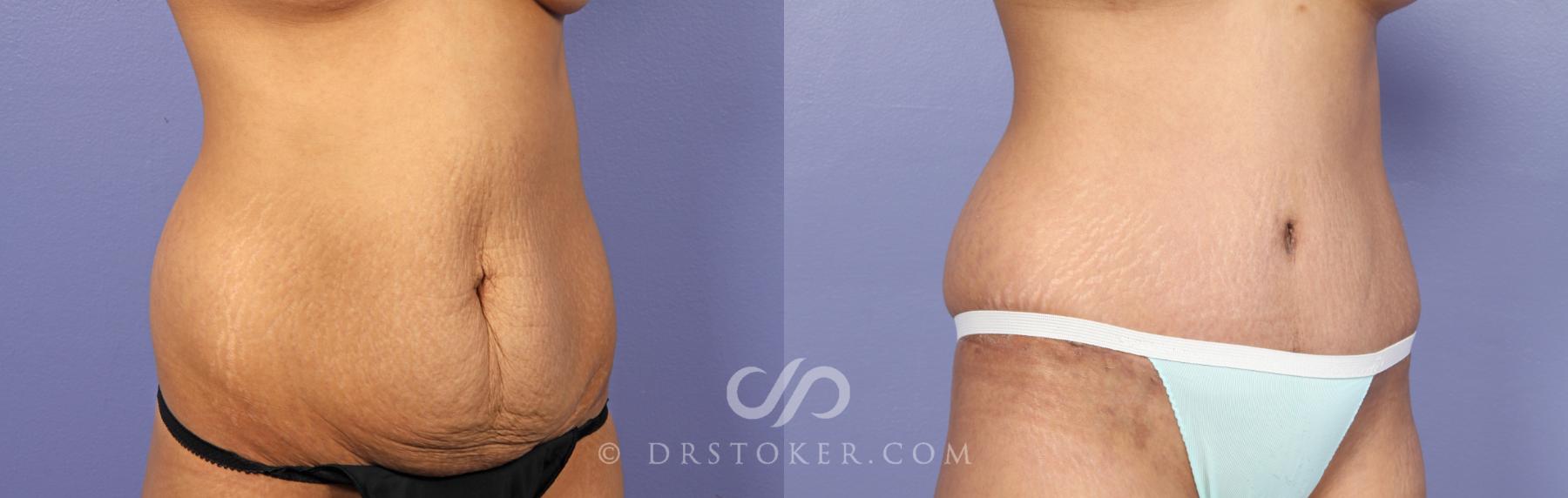 Before & After Tummy Tuck Case 469 View #2 View in Los Angeles, CA