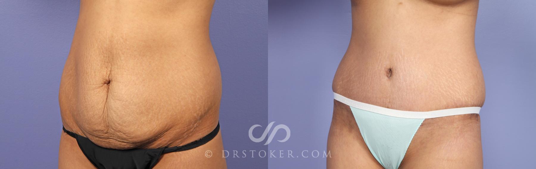 Before & After Tummy Tuck Case 469 View #3 View in Los Angeles, CA
