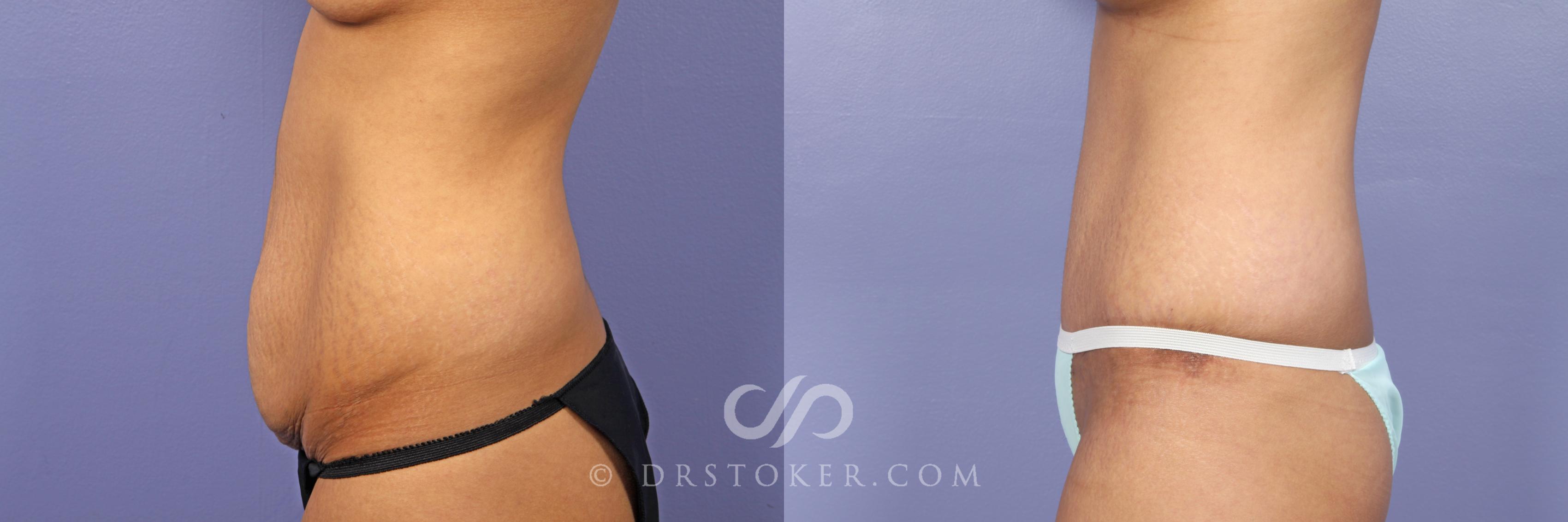 Before & After Tummy Tuck Case 469 View #5 View in Los Angeles, CA