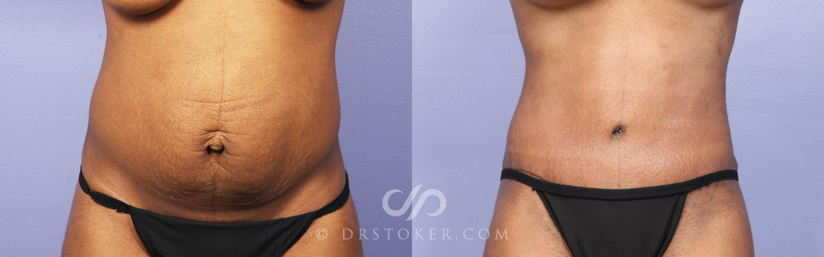Before & After Tummy Tuck Case 484 View #1 View in Los Angeles, CA