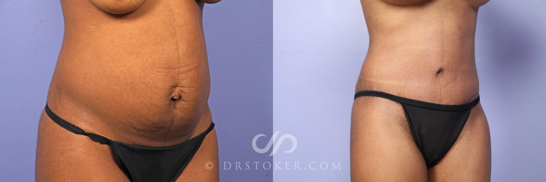 Before & After Tummy Tuck Case 484 View #2 View in Los Angeles, CA