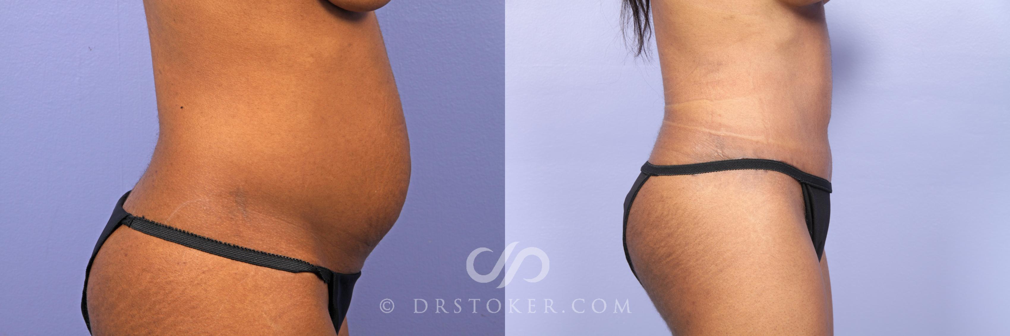 Before & After Tummy Tuck Case 484 View #3 View in Los Angeles, CA