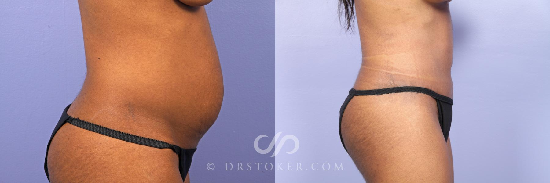 Before & After Tummy Tuck Case 484 View #3 View in Los Angeles, CA