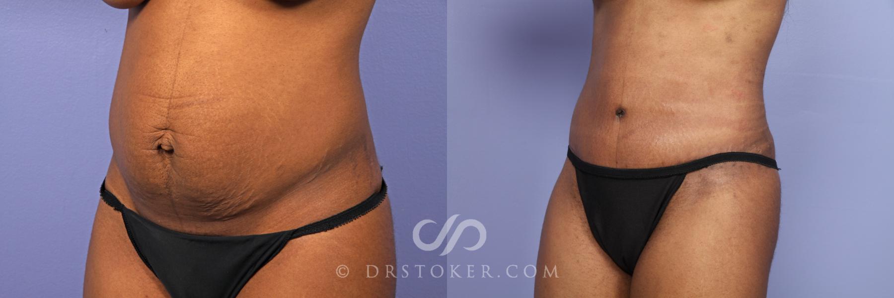Before & After Tummy Tuck Case 484 View #4 View in Los Angeles, CA