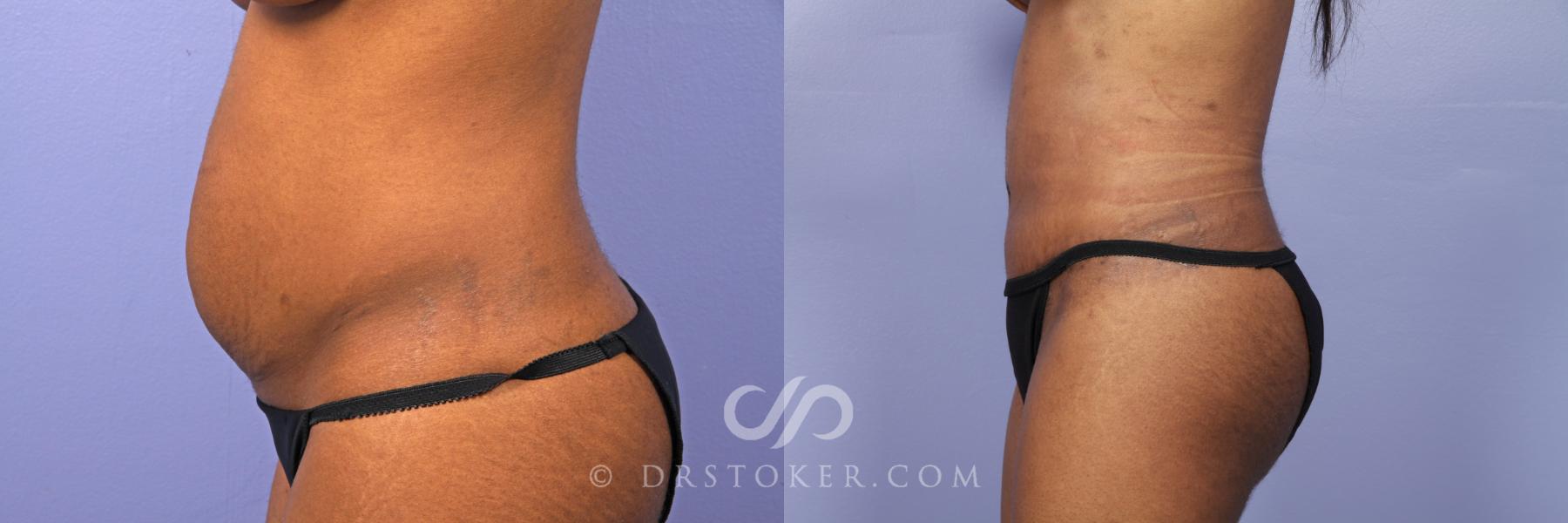 Before & After Tummy Tuck Case 484 View #5 View in Los Angeles, CA