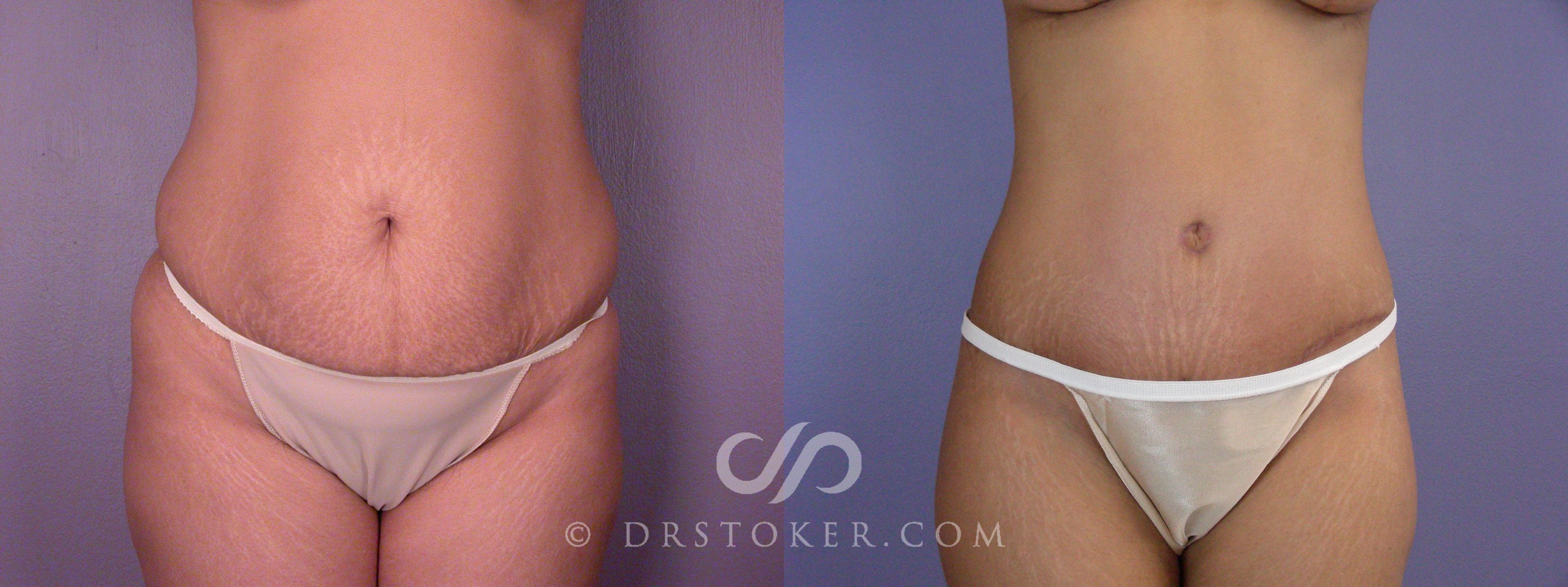 Before & After Tummy Tuck Case 499 View #1 View in Los Angeles, CA