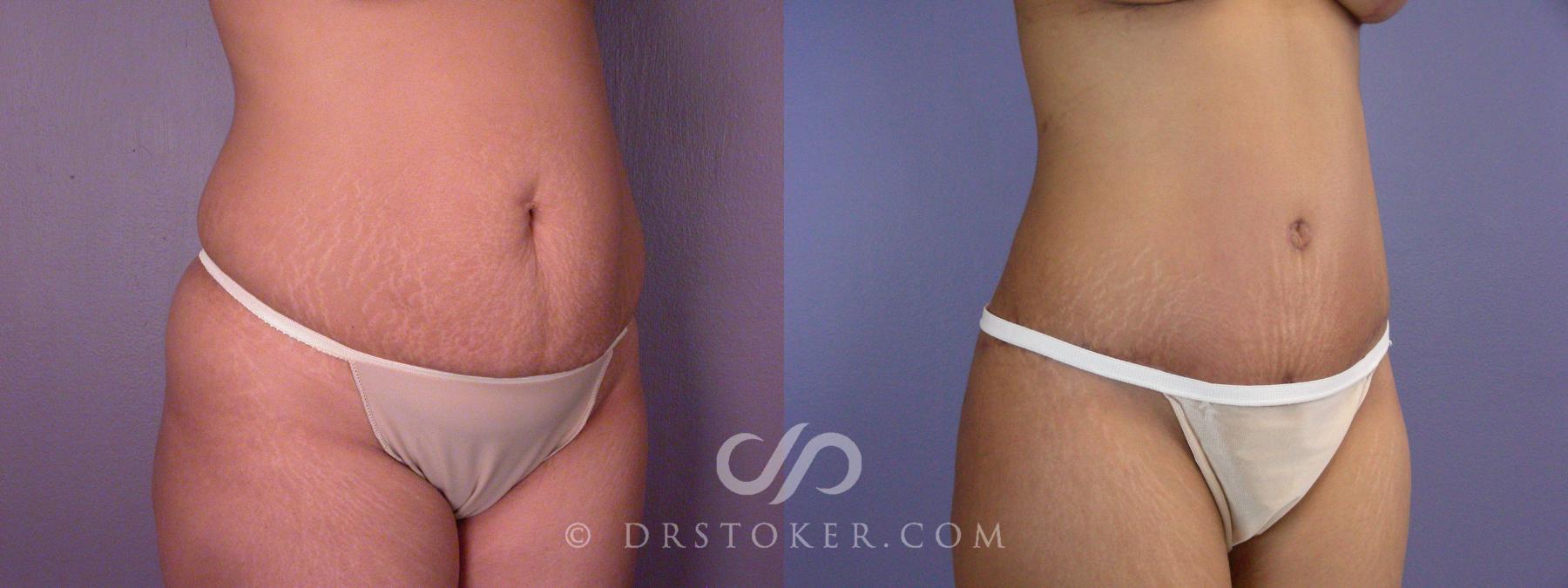 Before & After Tummy Tuck Case 499 View #2 View in Los Angeles, CA