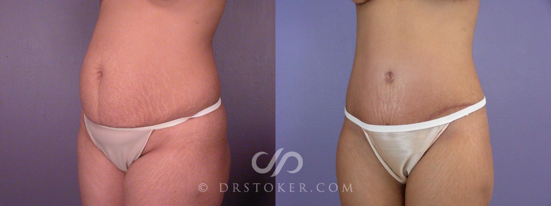 Before & After Tummy Tuck Case 499 View #3 View in Los Angeles, CA