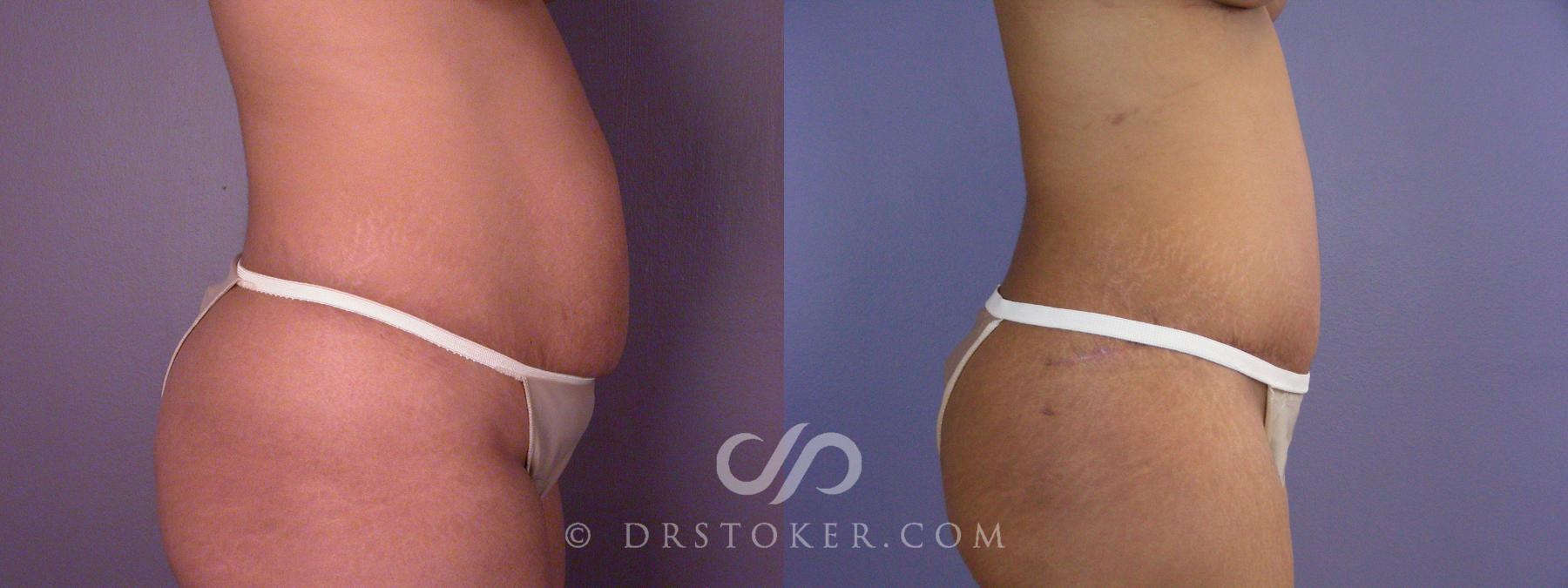 Before & After Tummy Tuck Case 499 View #4 View in Los Angeles, CA