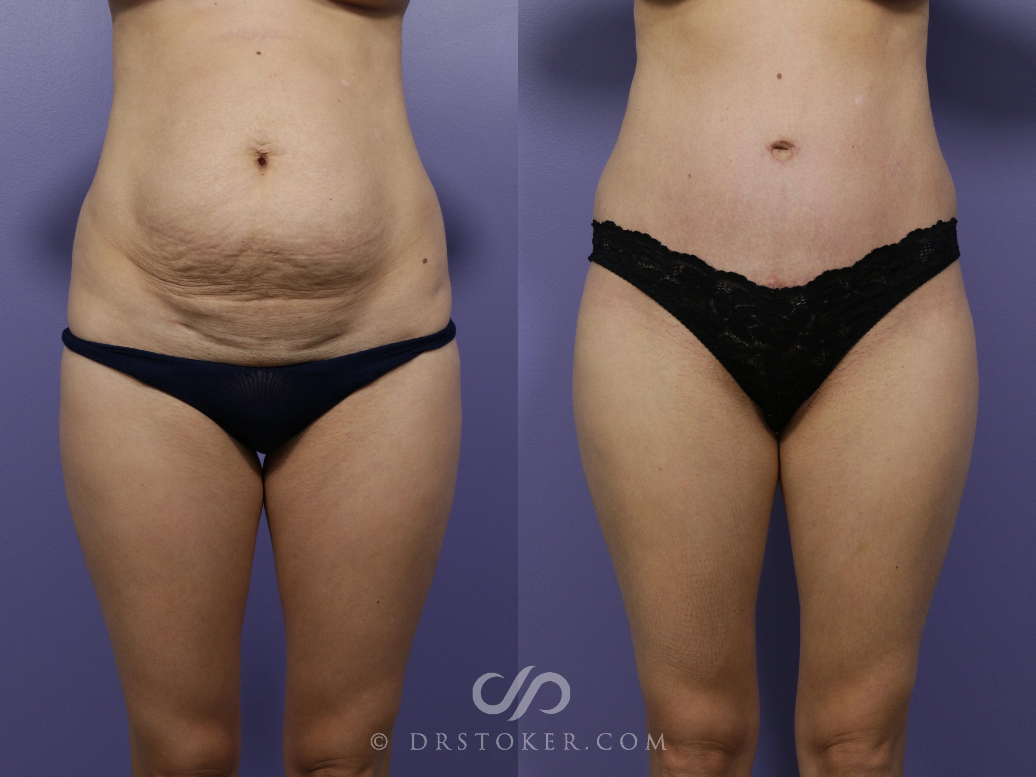 Before & After Tummy Tuck Case 760 View #1 View in Los Angeles, CA