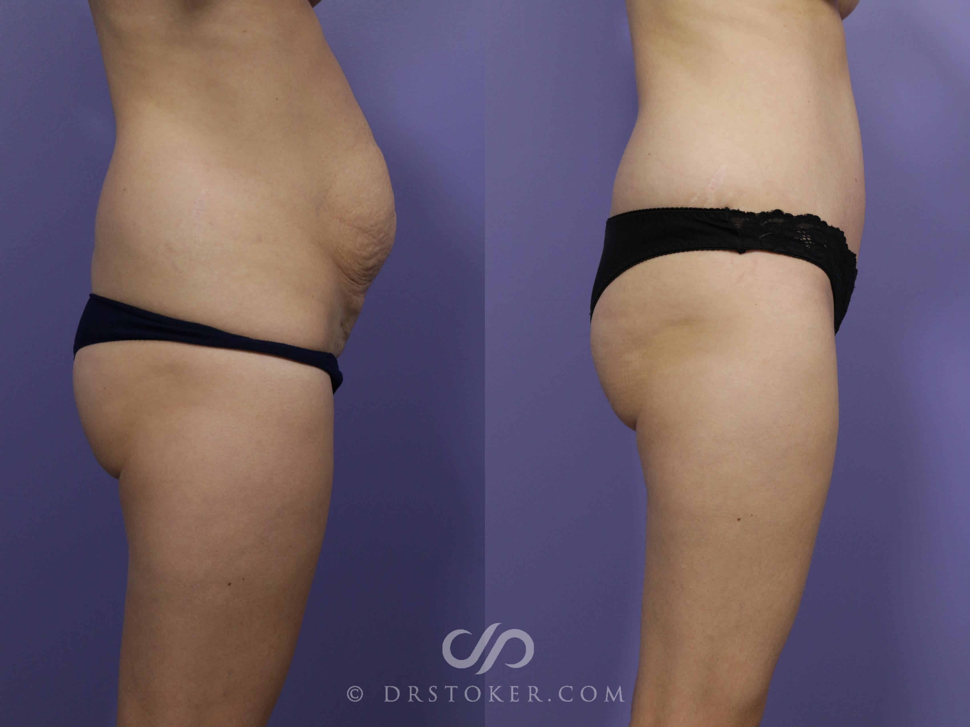 Before & After Tummy Tuck Case 760 View #2 View in Los Angeles, CA