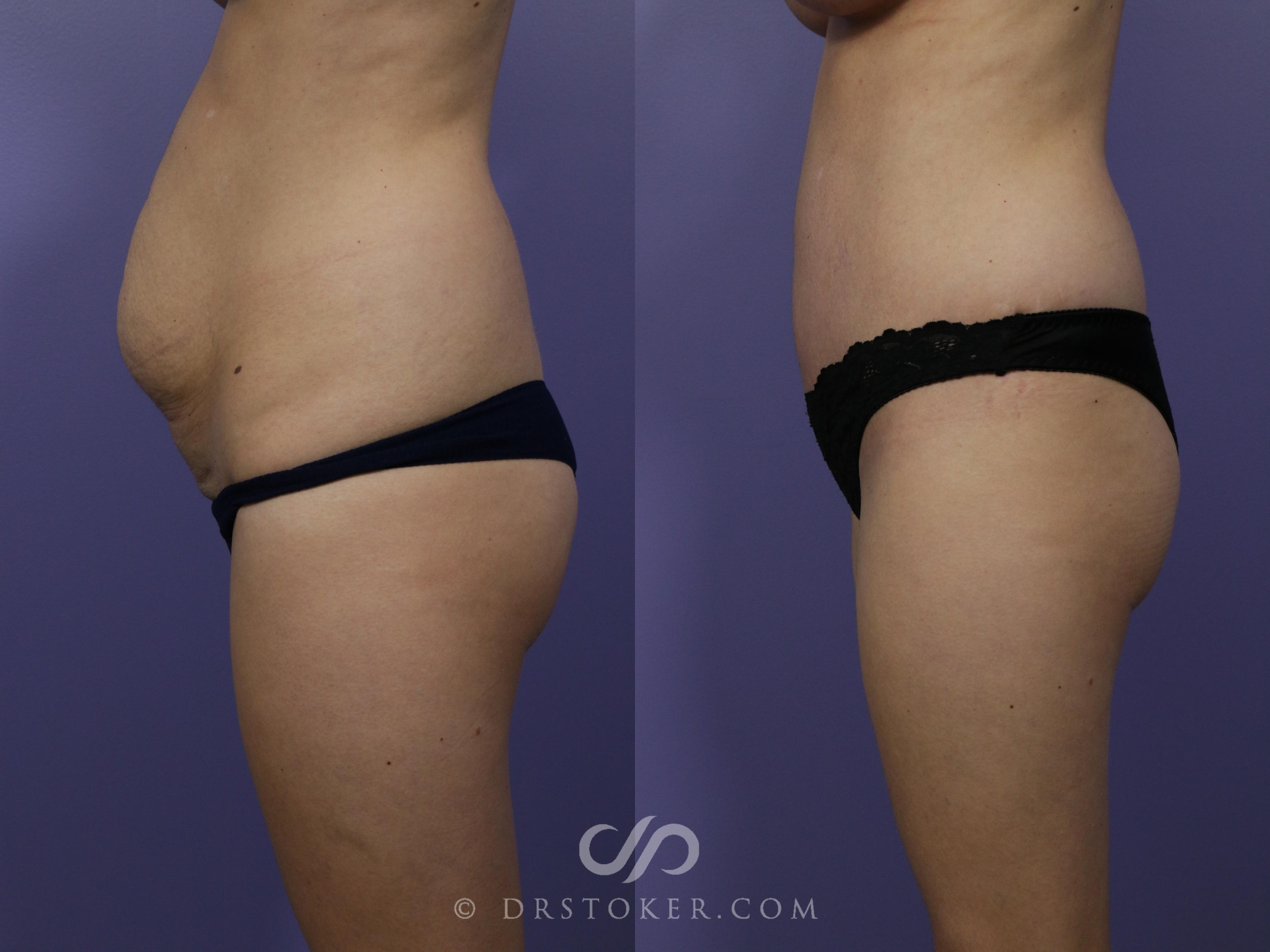 Before & After Tummy Tuck Case 760 View #3 View in Los Angeles, CA