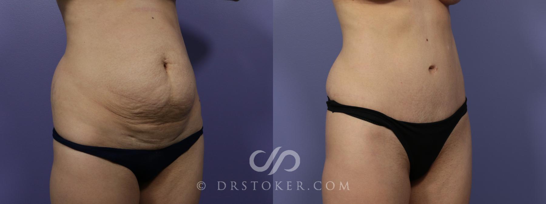Before & After Tummy Tuck Case 761 View #2 View in Los Angeles, CA