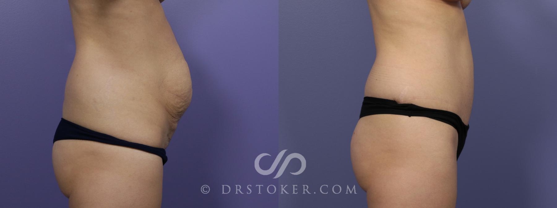 Before & After Tummy Tuck Case 761 View #3 View in Los Angeles, CA