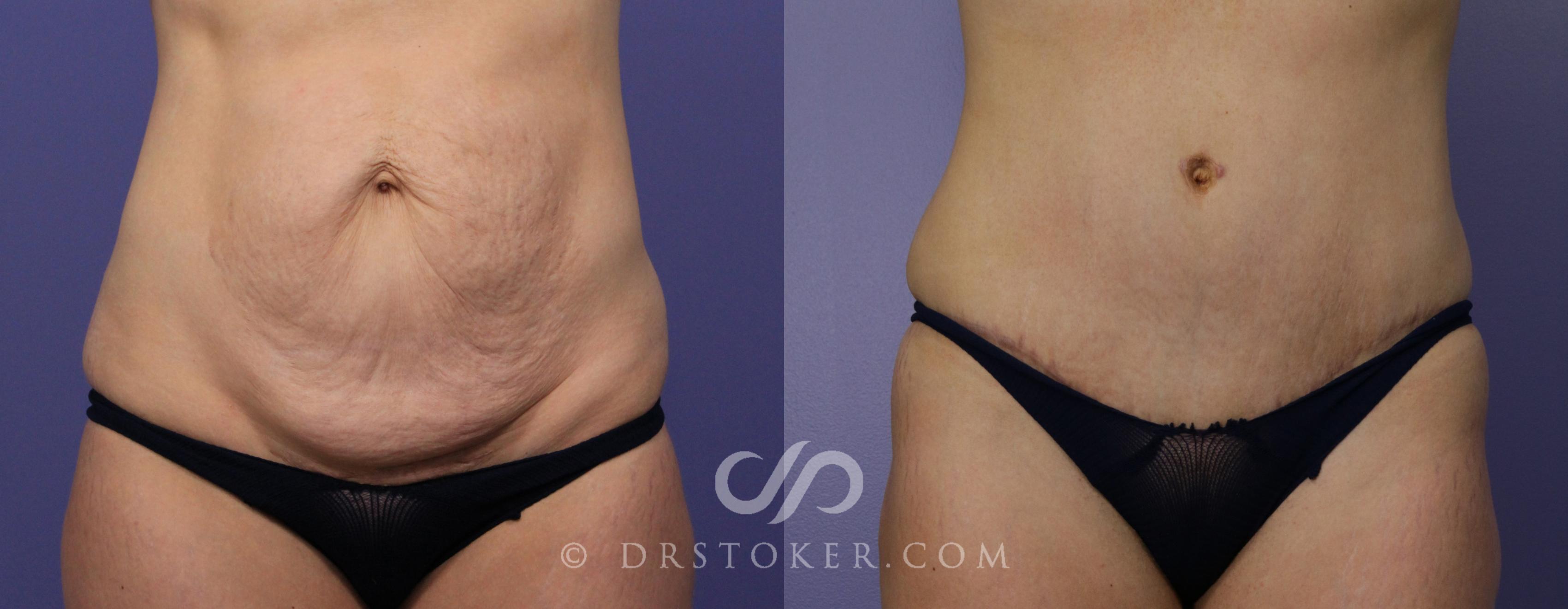 Before & After Tummy Tuck Case 762 View #1 View in Los Angeles, CA