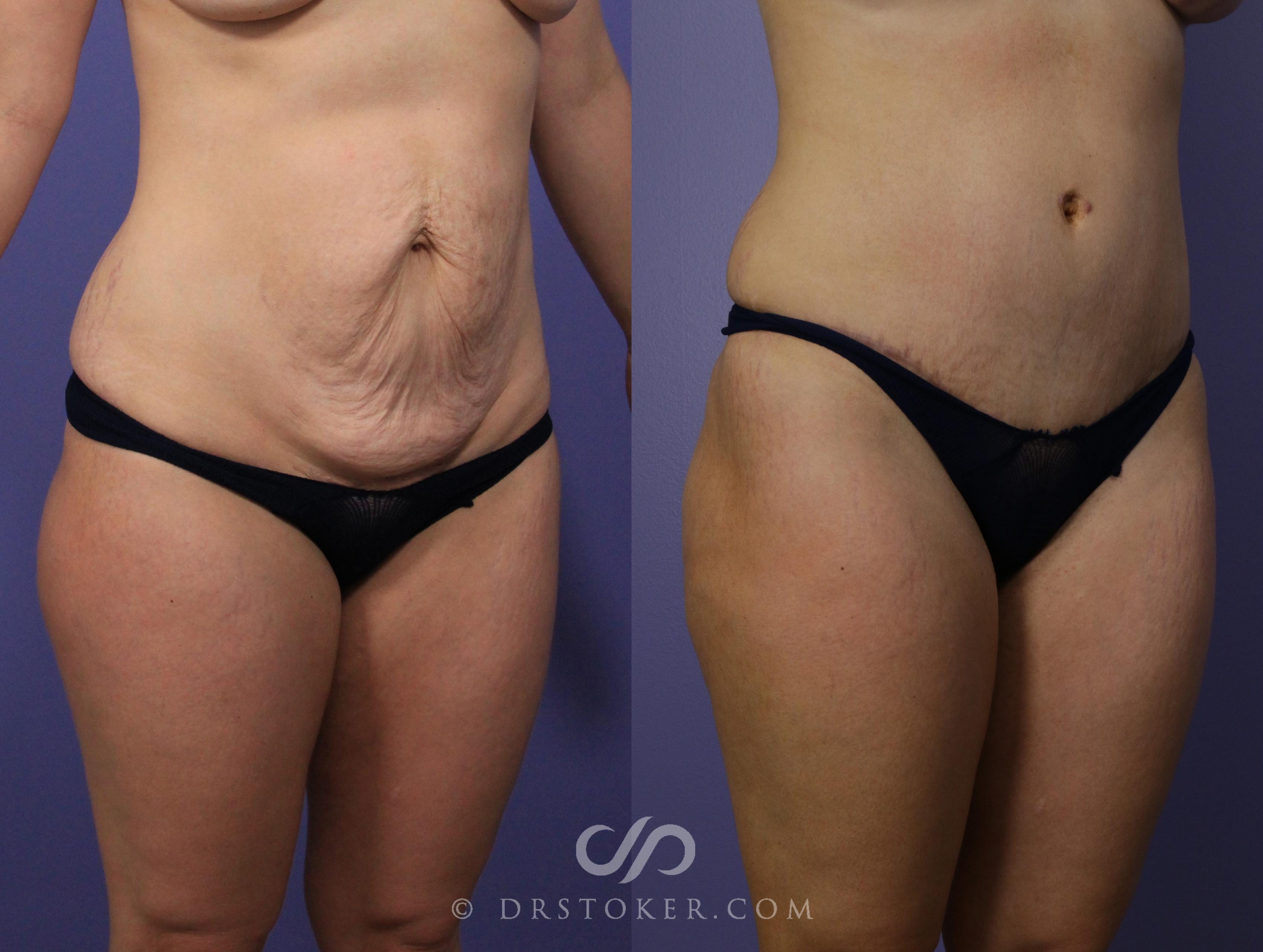 Before & After Tummy Tuck Case 762 View #2 View in Los Angeles, CA
