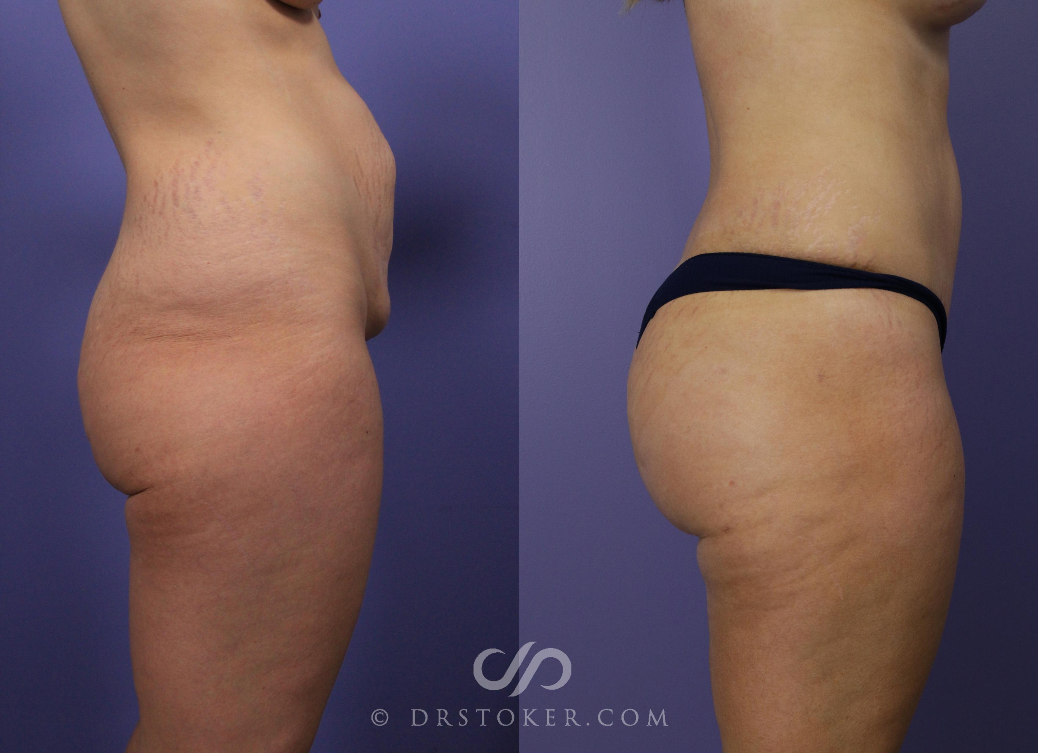 Before & After Tummy Tuck Case 762 View #3 View in Los Angeles, CA