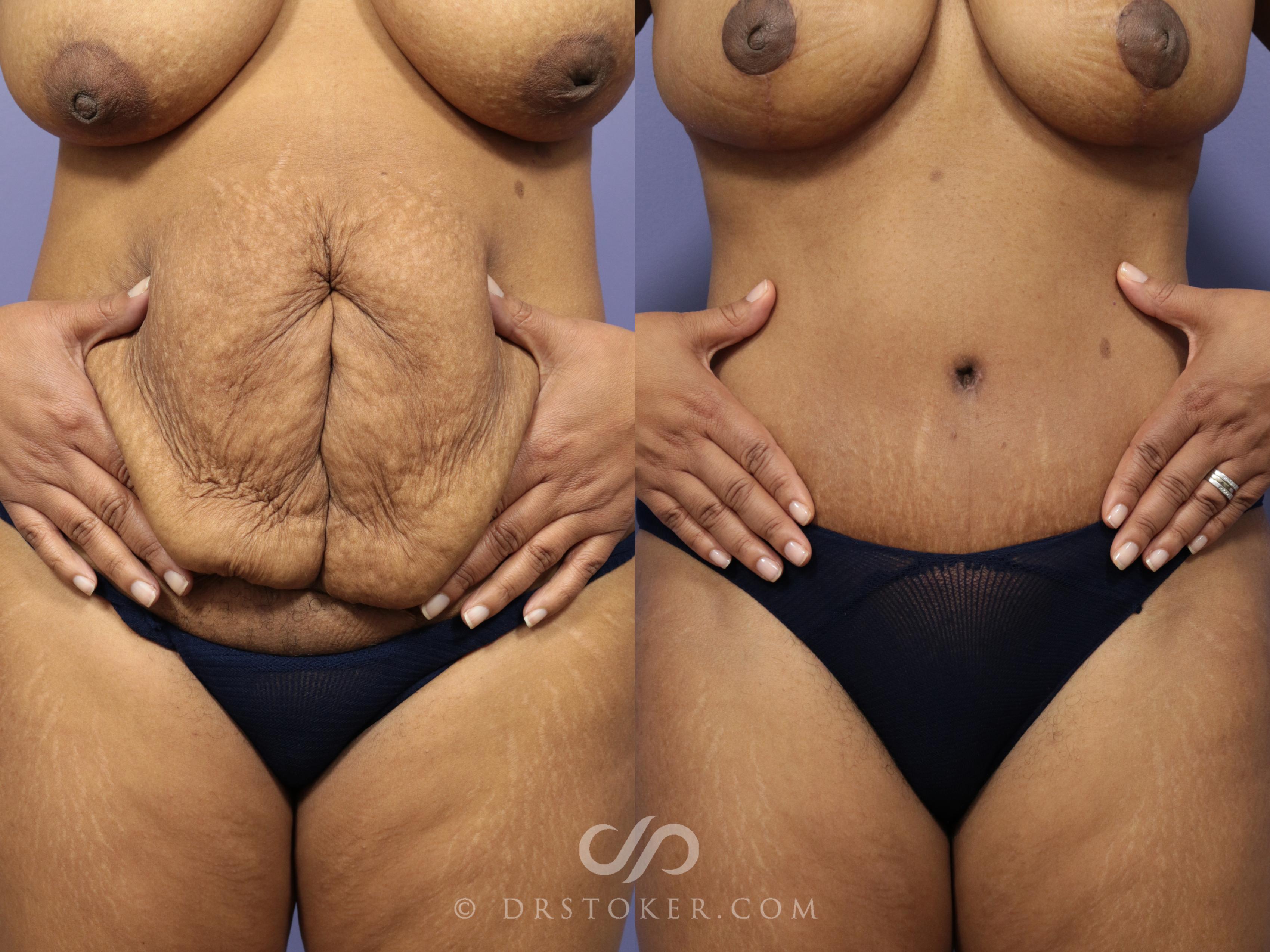 Before & After Tummy Tuck Case 763 View #4 View in Los Angeles, CA