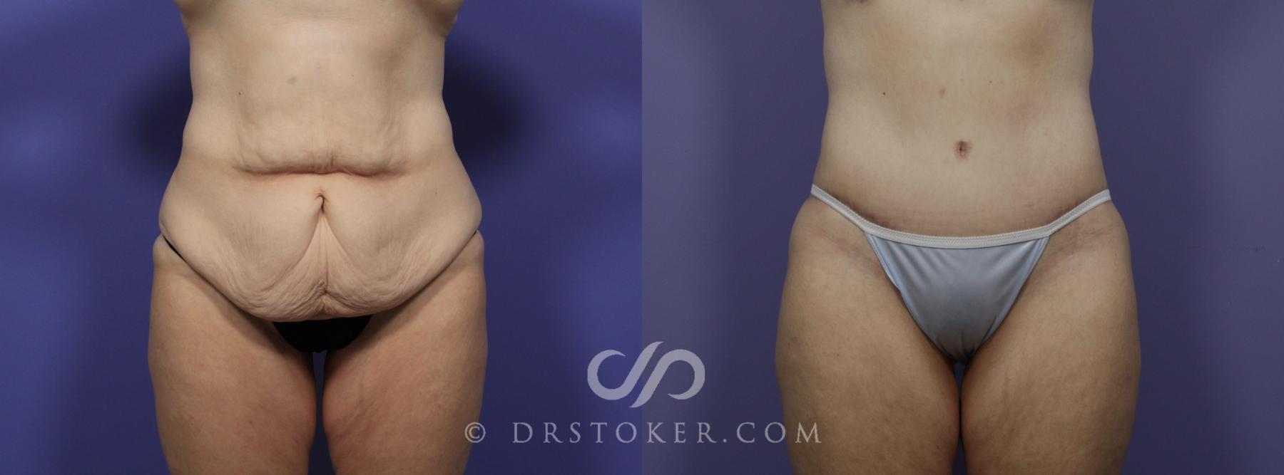 Before & After Tummy Tuck Case 765 View #1 View in Los Angeles, CA