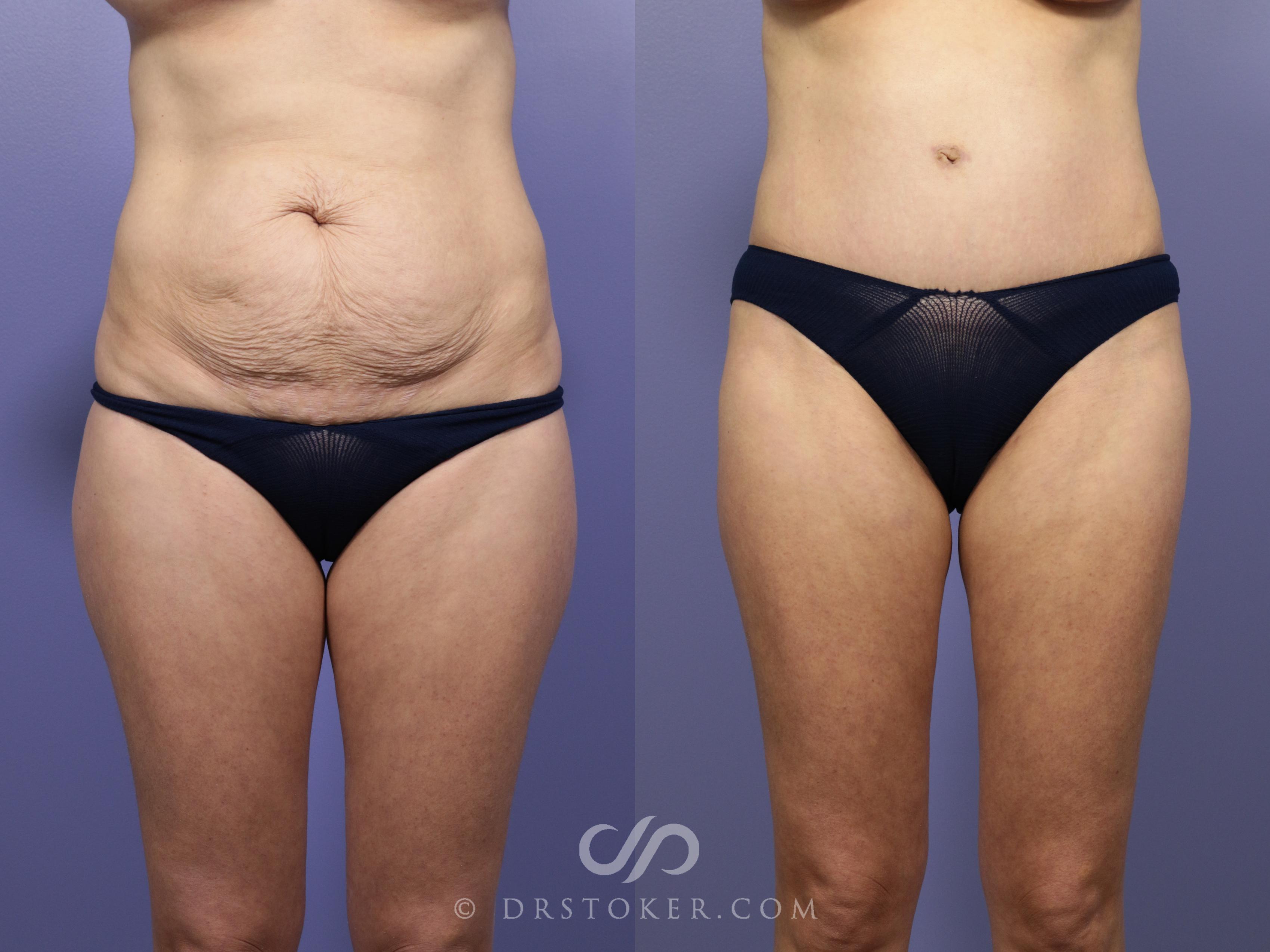 Before & After Tummy Tuck Case 766 View #1 View in Los Angeles, CA
