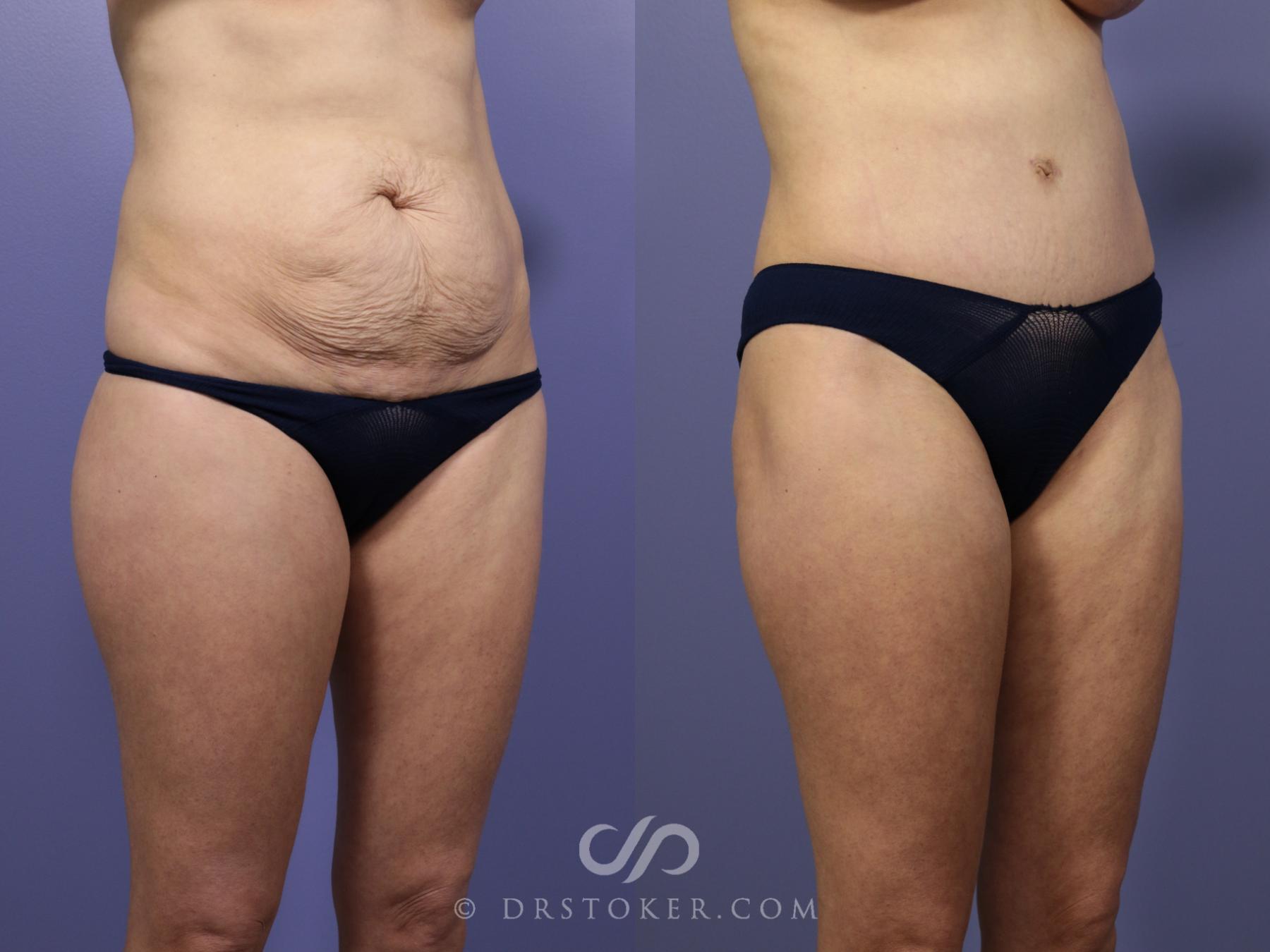 Before & After Tummy Tuck Case 766 View #3 View in Los Angeles, CA