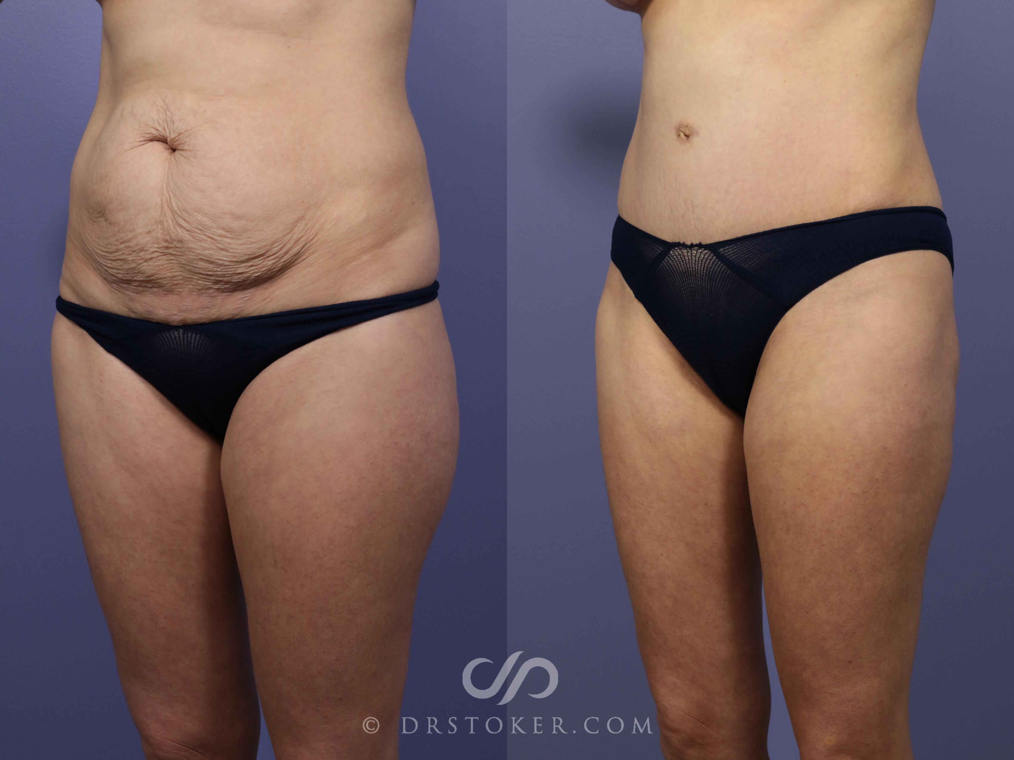 Before & After Tummy Tuck Case 766 View #4 View in Los Angeles, CA