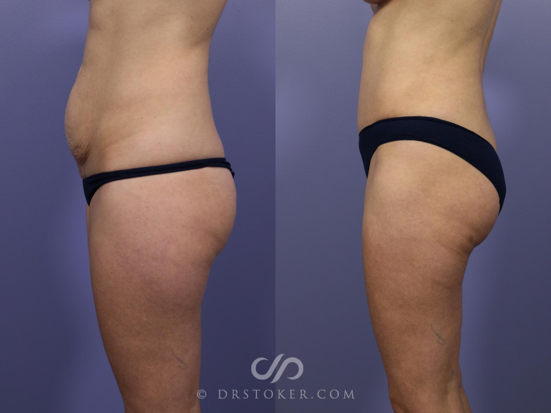 Before & After Tummy Tuck Case 766 View #5 View in Los Angeles, CA