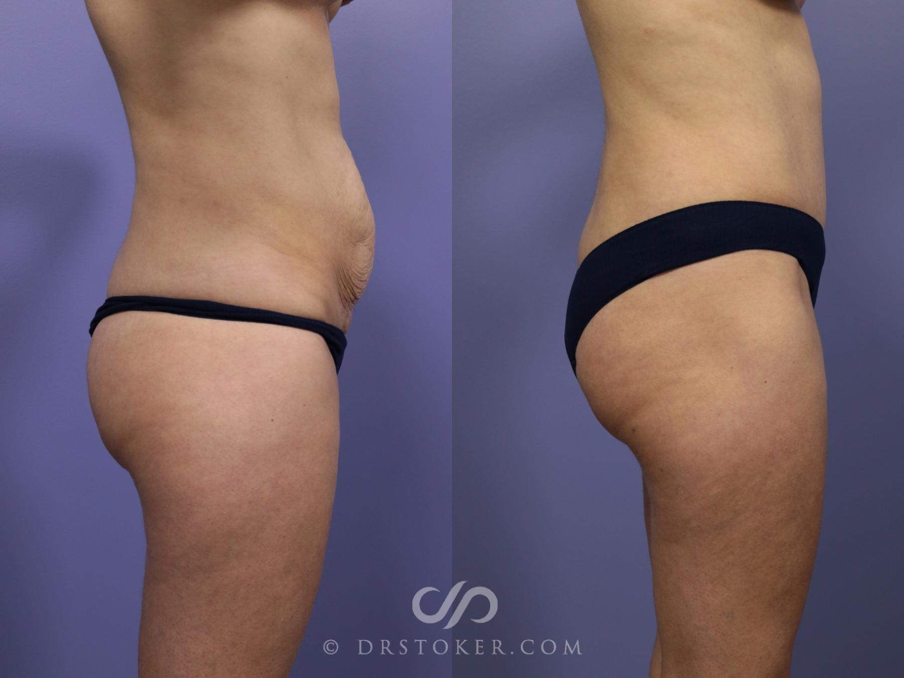 Before & After Tummy Tuck Case 766 View #6 View in Los Angeles, CA