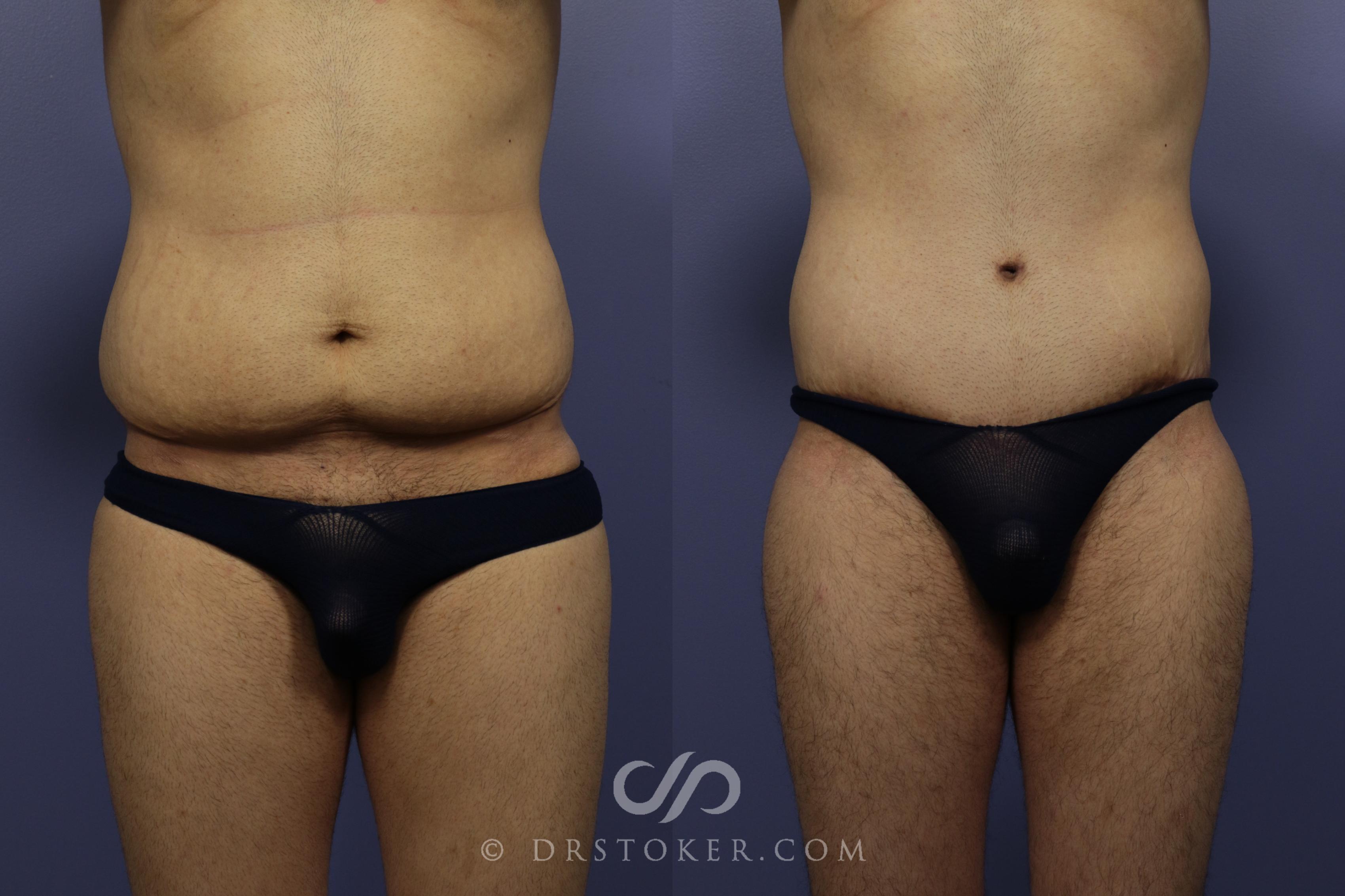 Before & After Tummy Tuck for Men Case 768 View #1 View in Los Angeles, CA