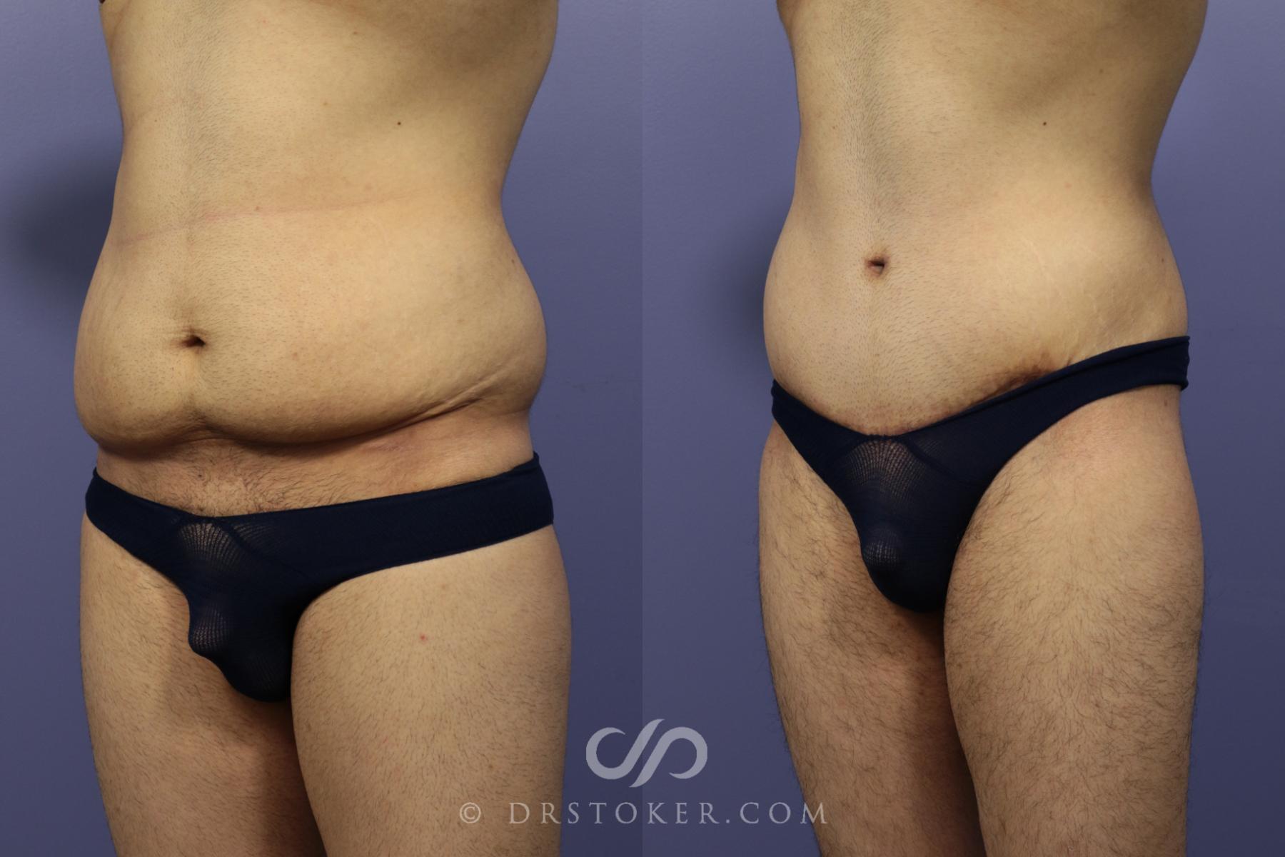 Before & After Tummy Tuck for Men Case 768 View #2 View in Los Angeles, CA