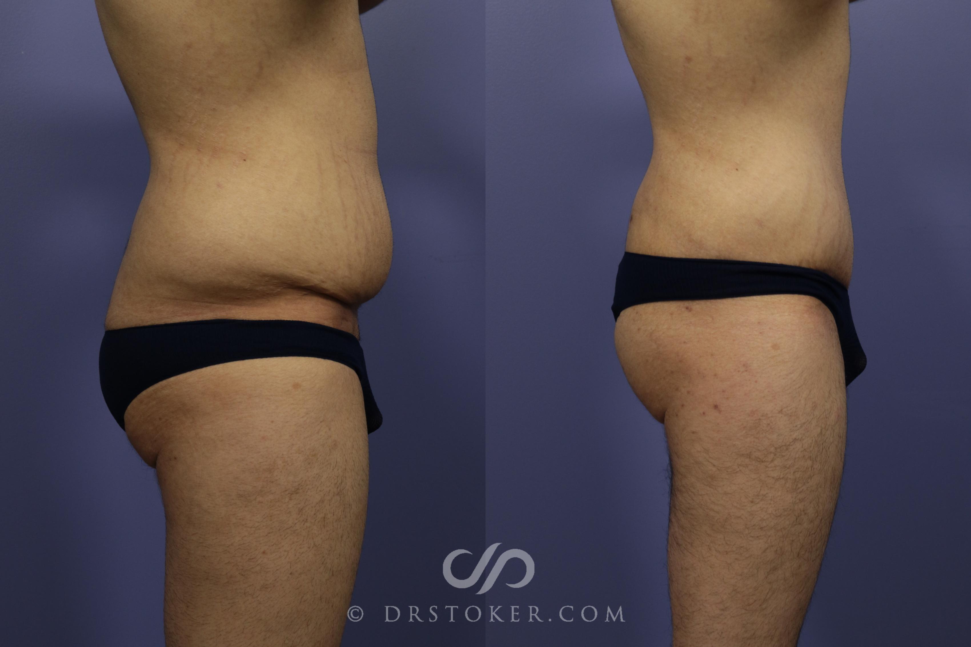 Before & After Tummy Tuck for Men Case 768 View #3 View in Los Angeles, CA