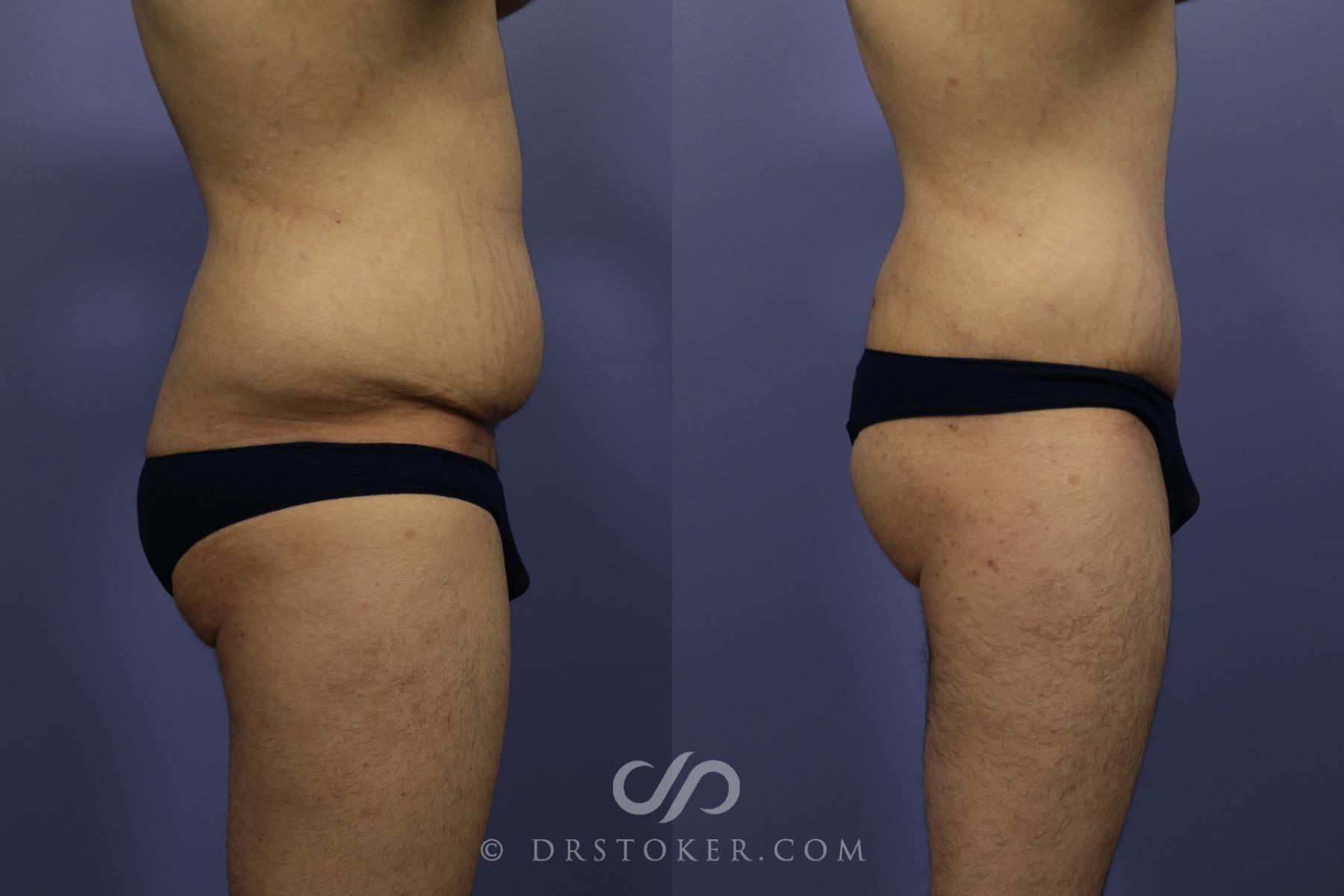 Before & After Tummy Tuck for Men Case 768 View #3 View in Los Angeles, CA