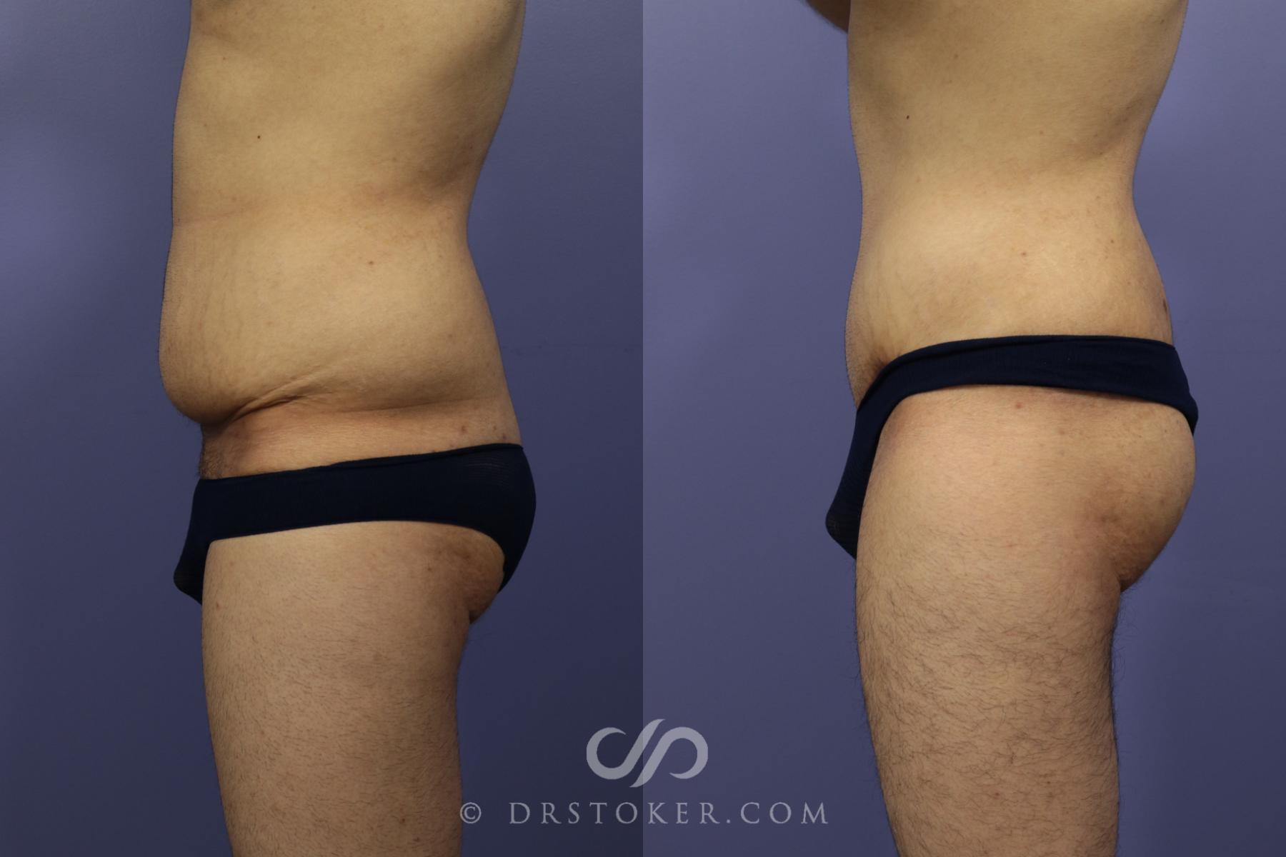 Before & After Tummy Tuck Case 768 View #4 View in Los Angeles, CA