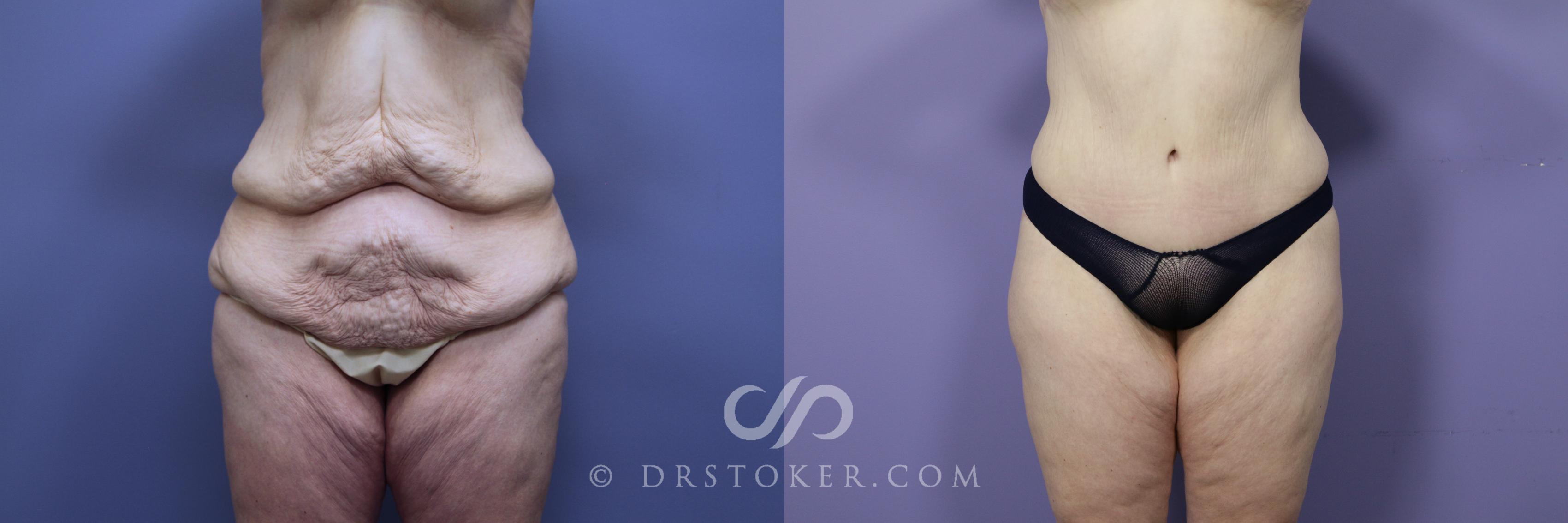 Before & After Tummy Tuck Case 770 View #1 View in Los Angeles, CA