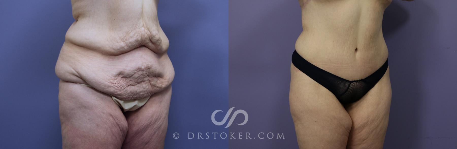 Before & After Tummy Tuck Case 770 View #2 View in Los Angeles, CA