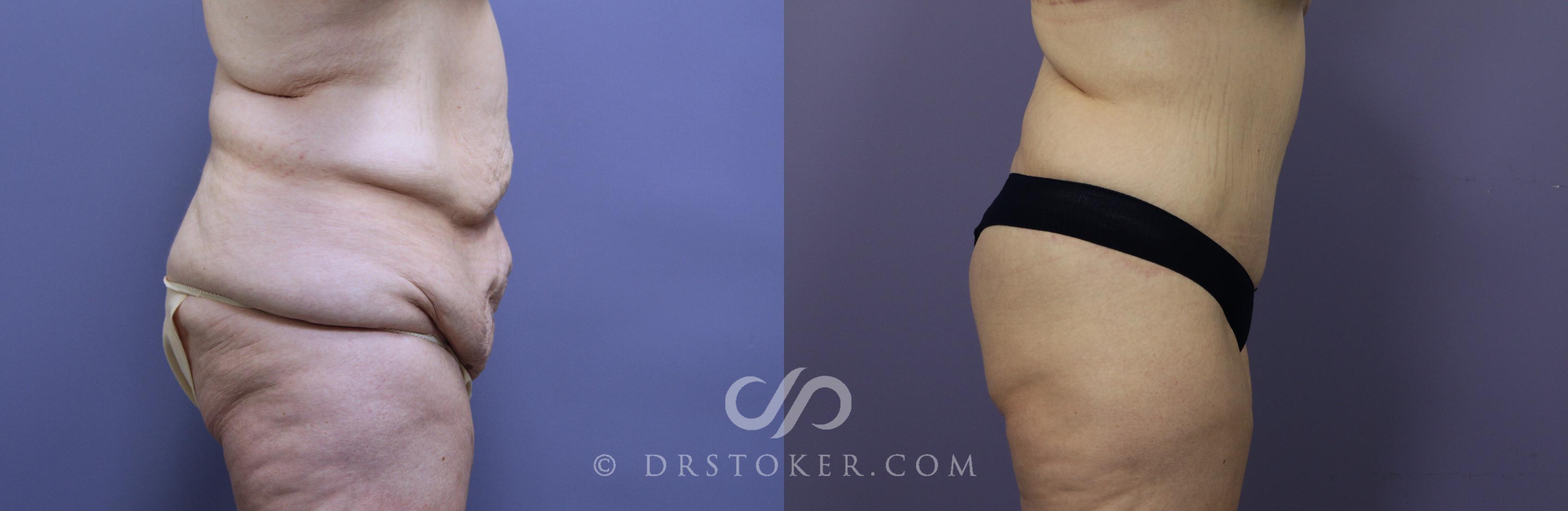 Before & After Tummy Tuck Case 770 View #3 View in Los Angeles, CA